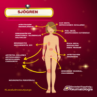 ​Cerca de 120.000 españoles padecen síndrome de Sjögren, y el 80% de ellos sufre fatiga
