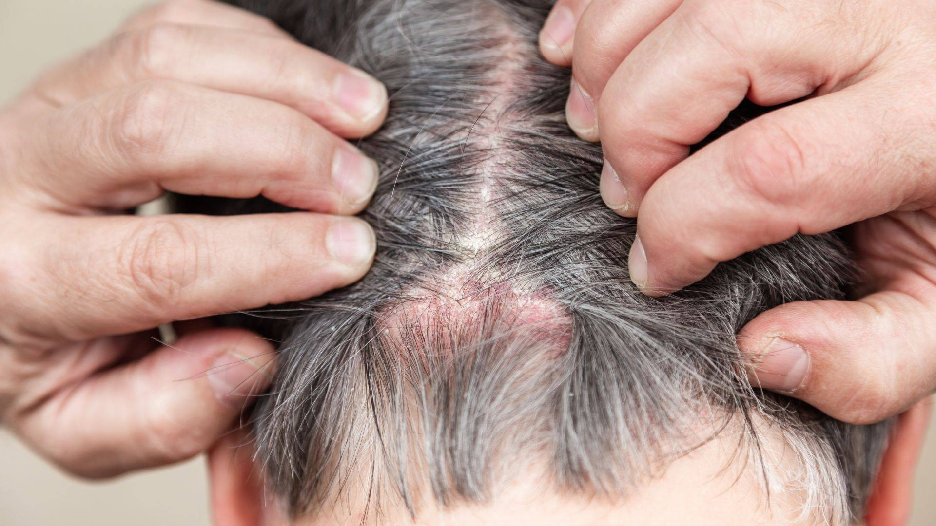 Alopecia tiña del cuero cabelludo, ¿pueden perros?