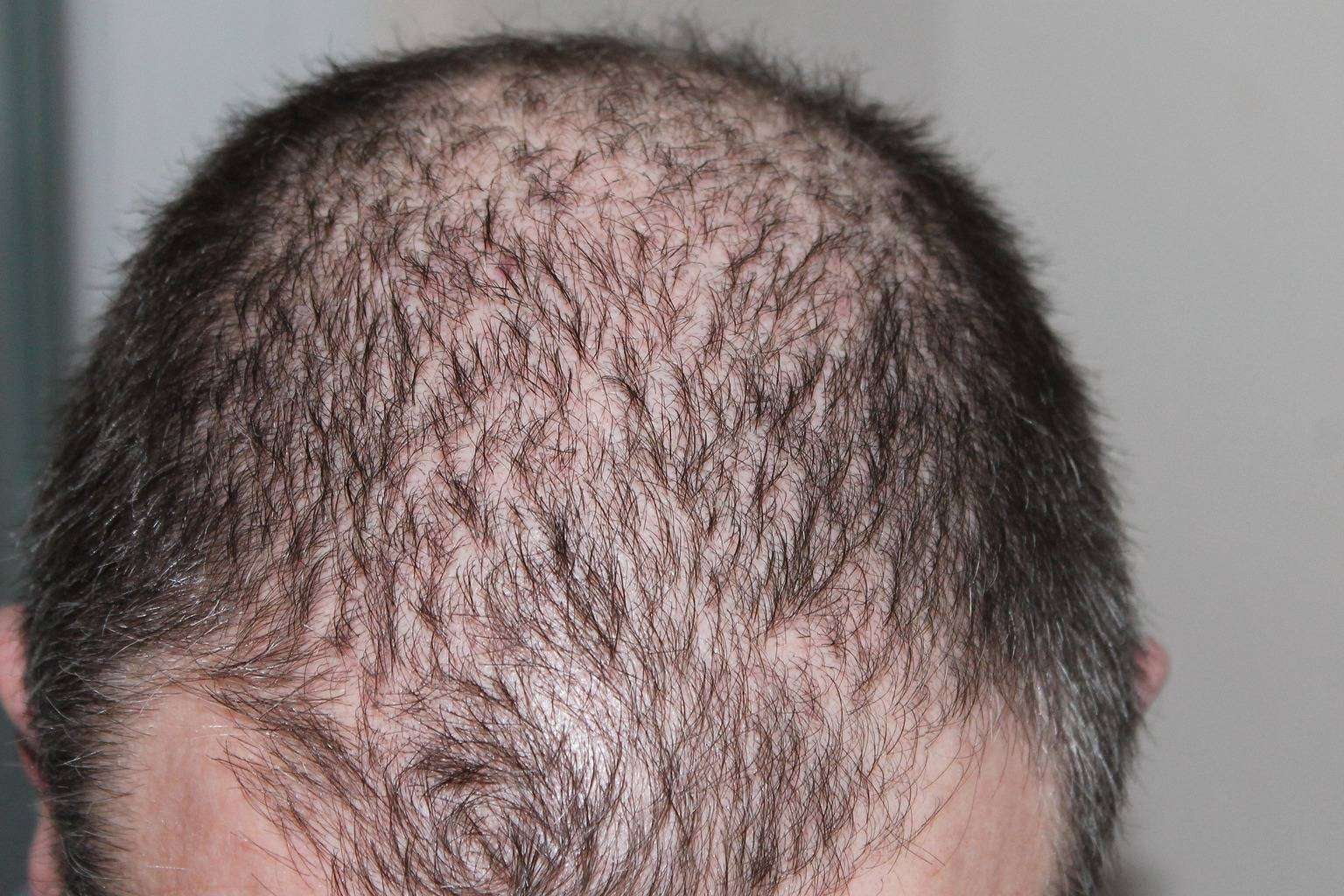 Mesoterapia capilar con antiandrógenos, un arma eficaz contra la alopecia androgenética