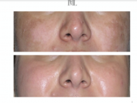 ​¿Manchas en el rostro?