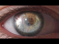 Glaucoma y edema macular diabético, dos de las principales causas de ceguera irreversible en España