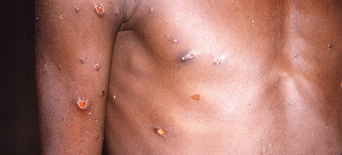 EuropaPress 4557724 viruela mono produce lesiones cutaneas fiebre dolor corporal personas