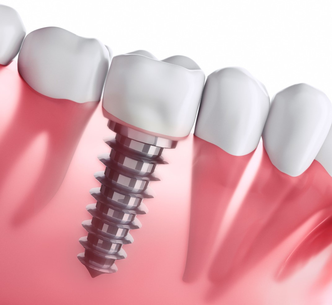 Custom dental   IP
