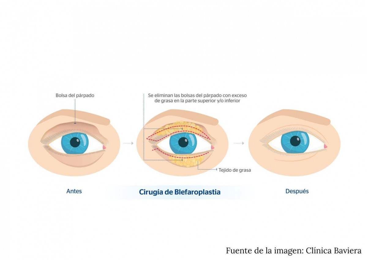25.2 blefaroplastia