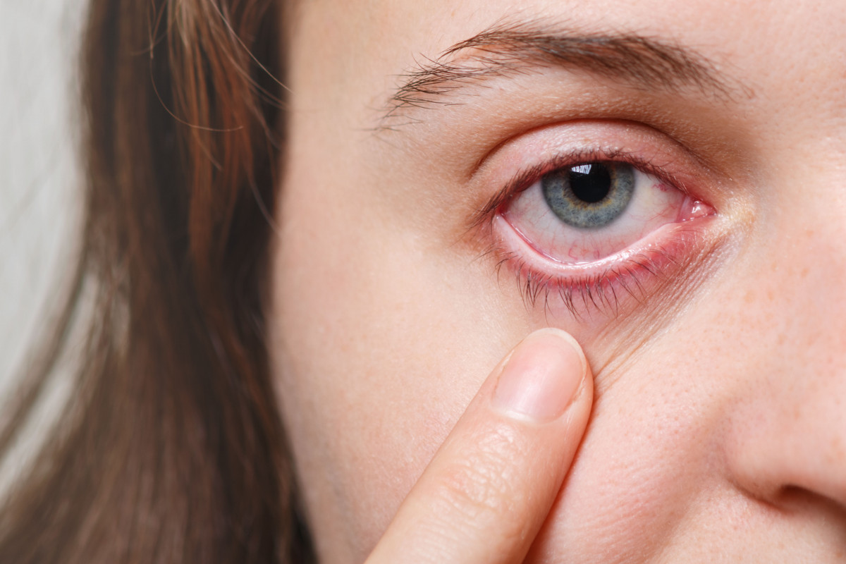 6. Conjuntivitis 2