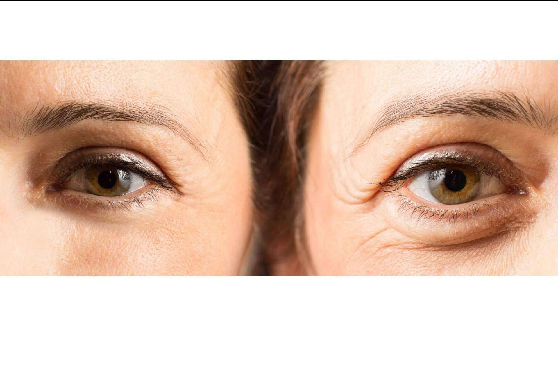 Ácido hialurónico para combatir las ojeras en la Unidad de medicina estética FEMME de Santiago de Compostela con la Dra. Alfonsina Uriburu