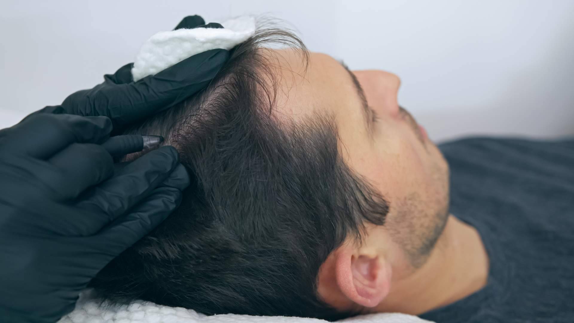 Micropigmentación Capilar en Distrito Wellness Concept