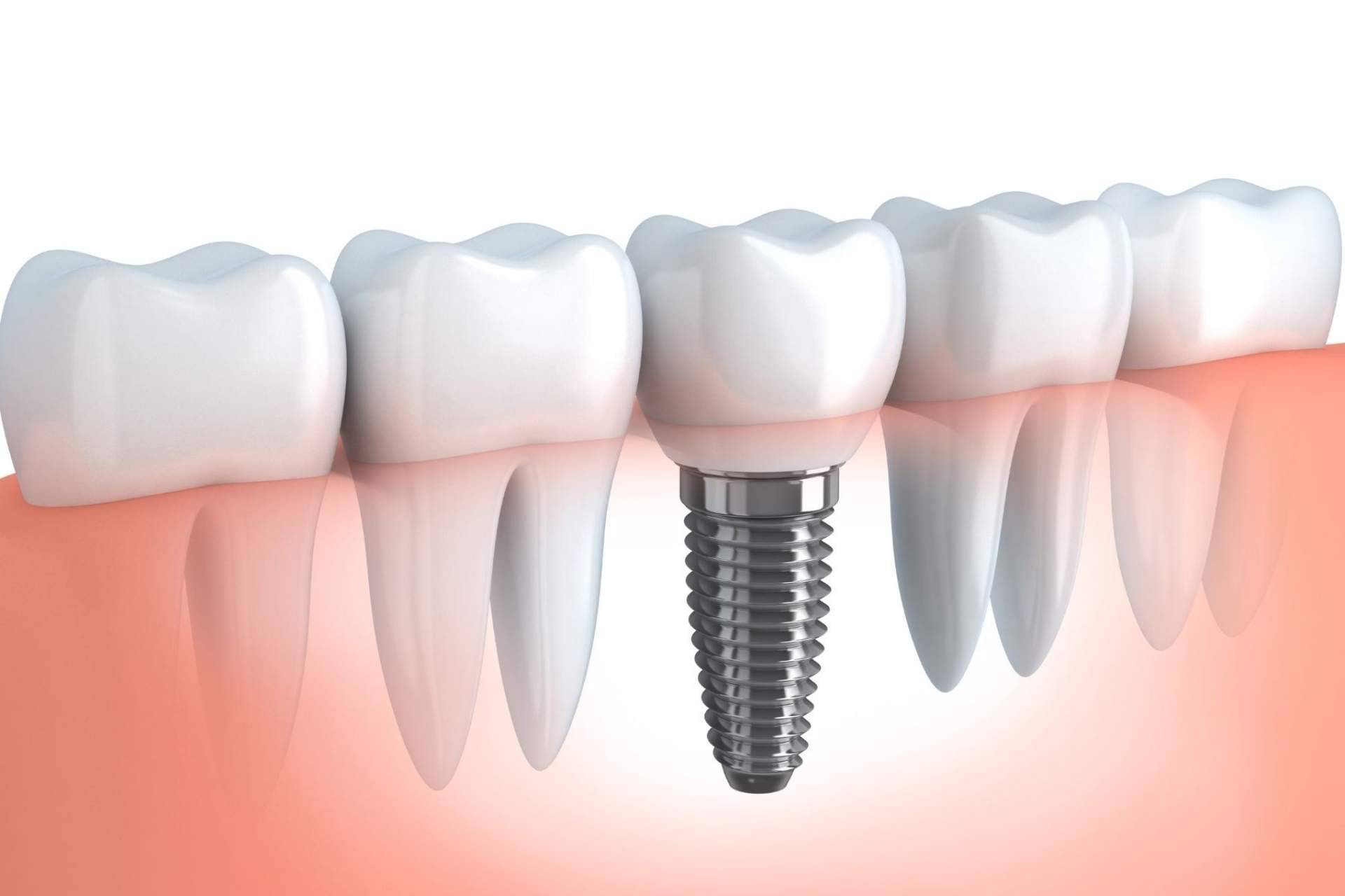 Los implantes de carga inmediata de Implant Clinics
