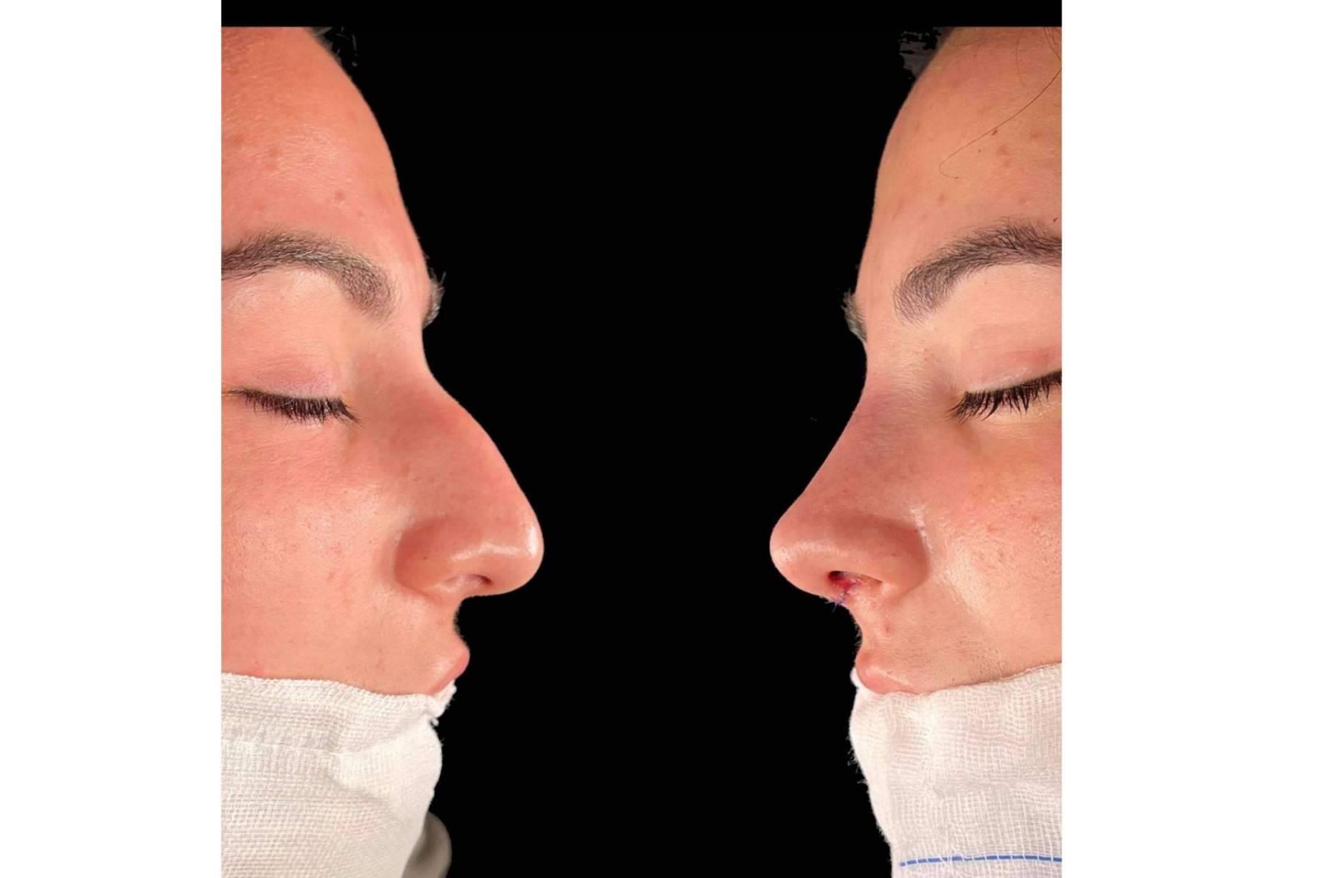 Cómo recuperarse de una rinoplastia, con el Dr. Pérez Villar