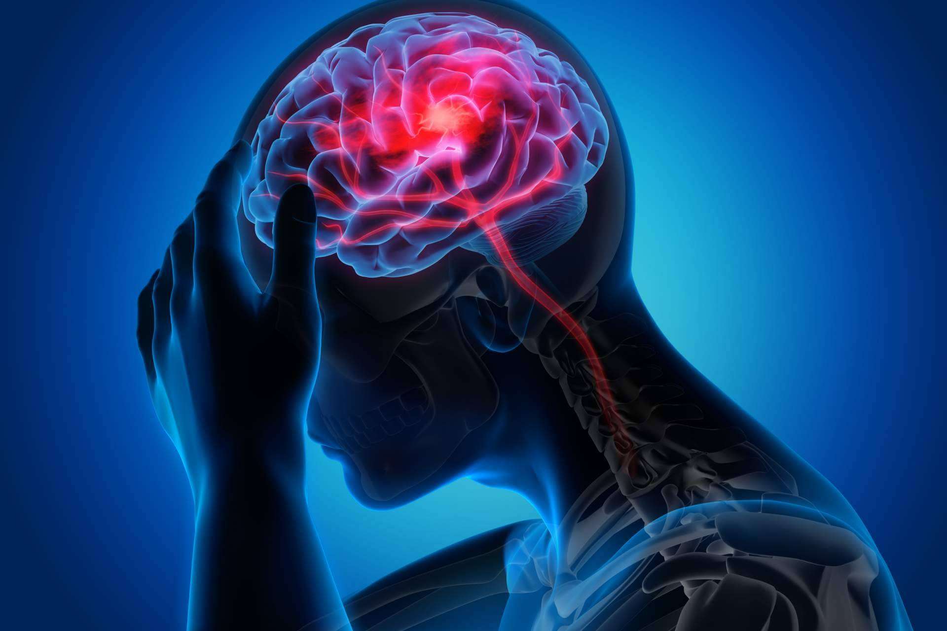 Fisioterapia para aliviar las migrañas, por Clínica Viasalud