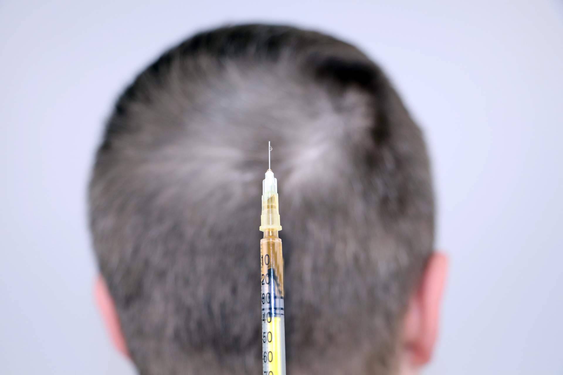 Mesoterapia capilar, cuidado profundo del cuero cabelludo ante la caída del cabello con el Dr. Bruno Jacobovski