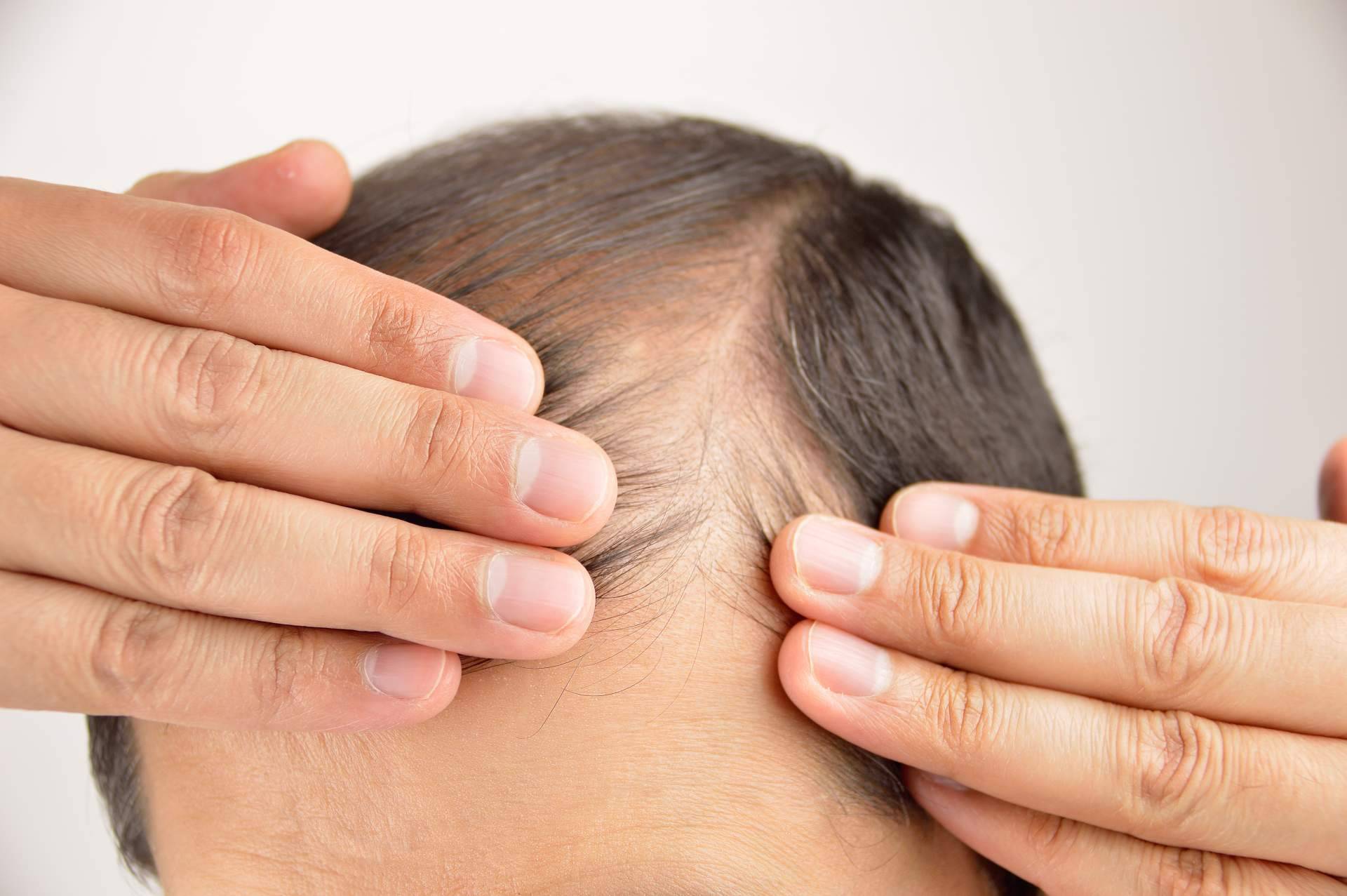 Новый лоб. Лечение выпадения волос. Выпадение волос мезотерапия. Психосоматика перхоти у мужчин. Облысение в разных странах Европы.