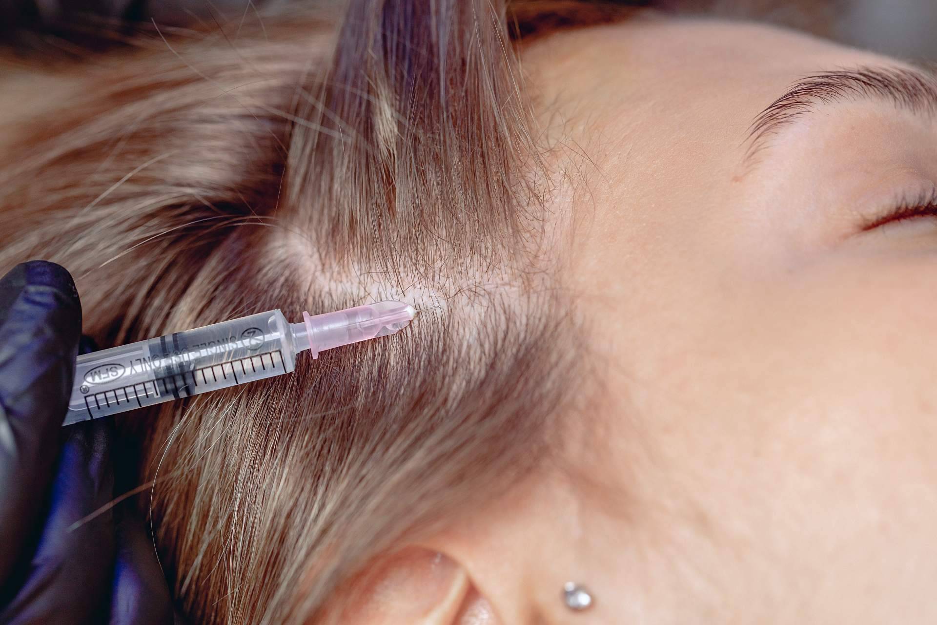 ¿En qué consiste, cuáles son los efectos y la recuperación de la mesoterapia capilar?, por Élite Capilar
