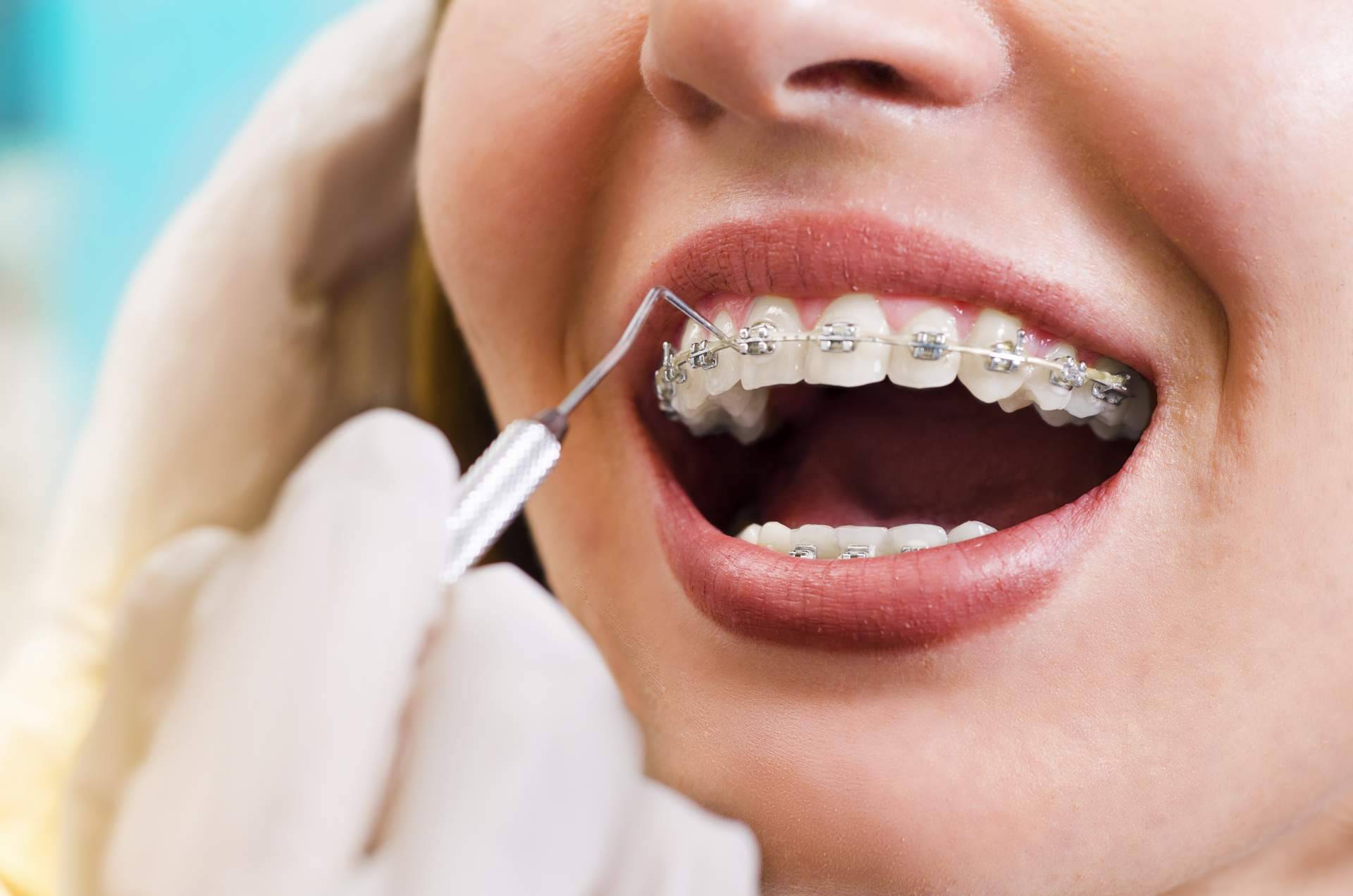 Dientes rectos, ¿estética o salud?