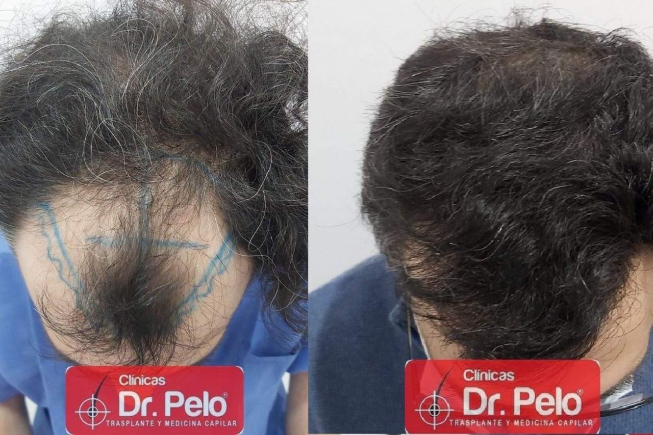 Injerto capilar Sevilla en la Clínica Dr. Pelo