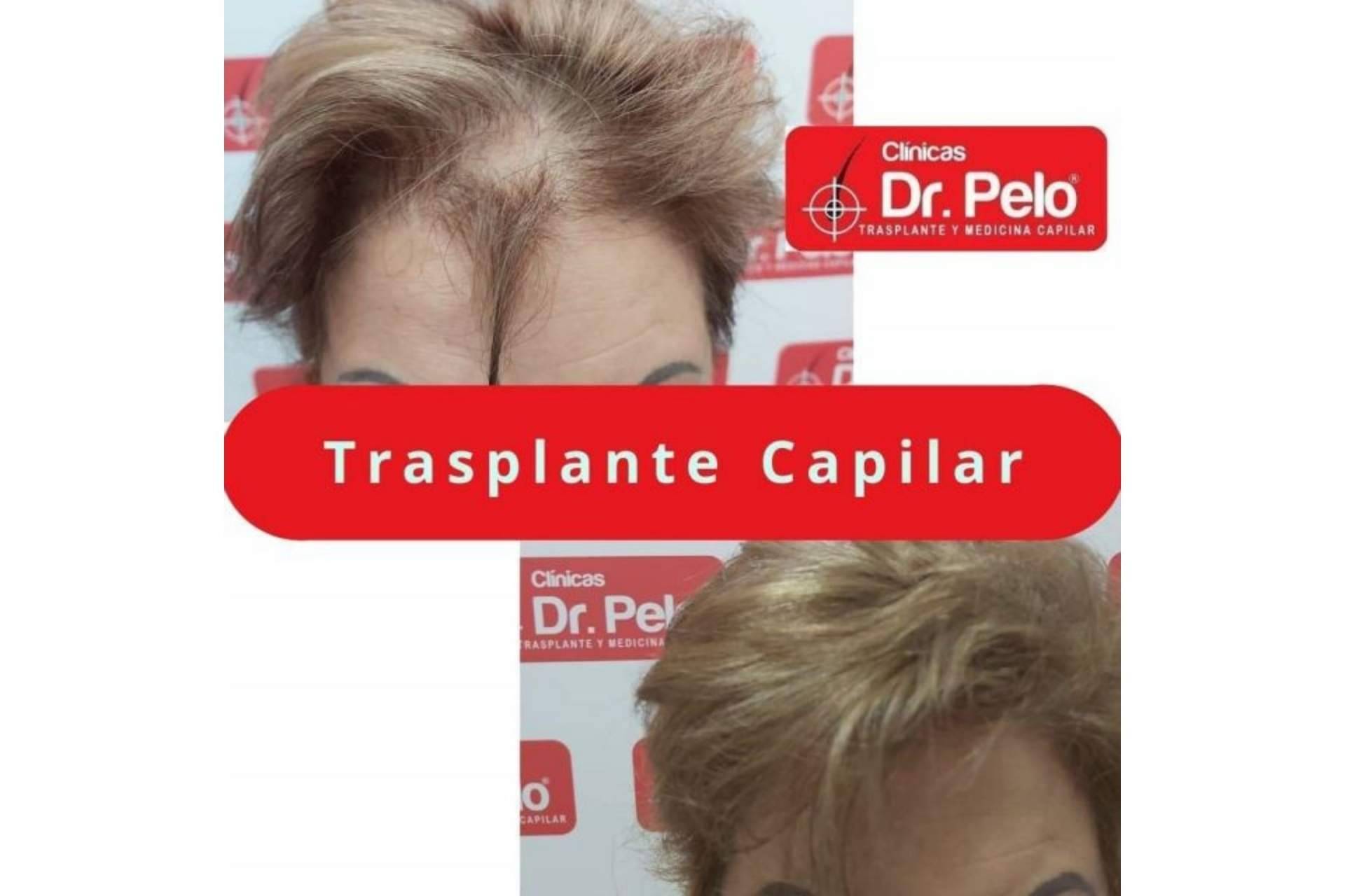 ¿Cómo frenar las entradas en el pelo gracias a las Clínicas Dr. Pelo? La importancia del trasplante capilar cuando existe una pérdida de cabello