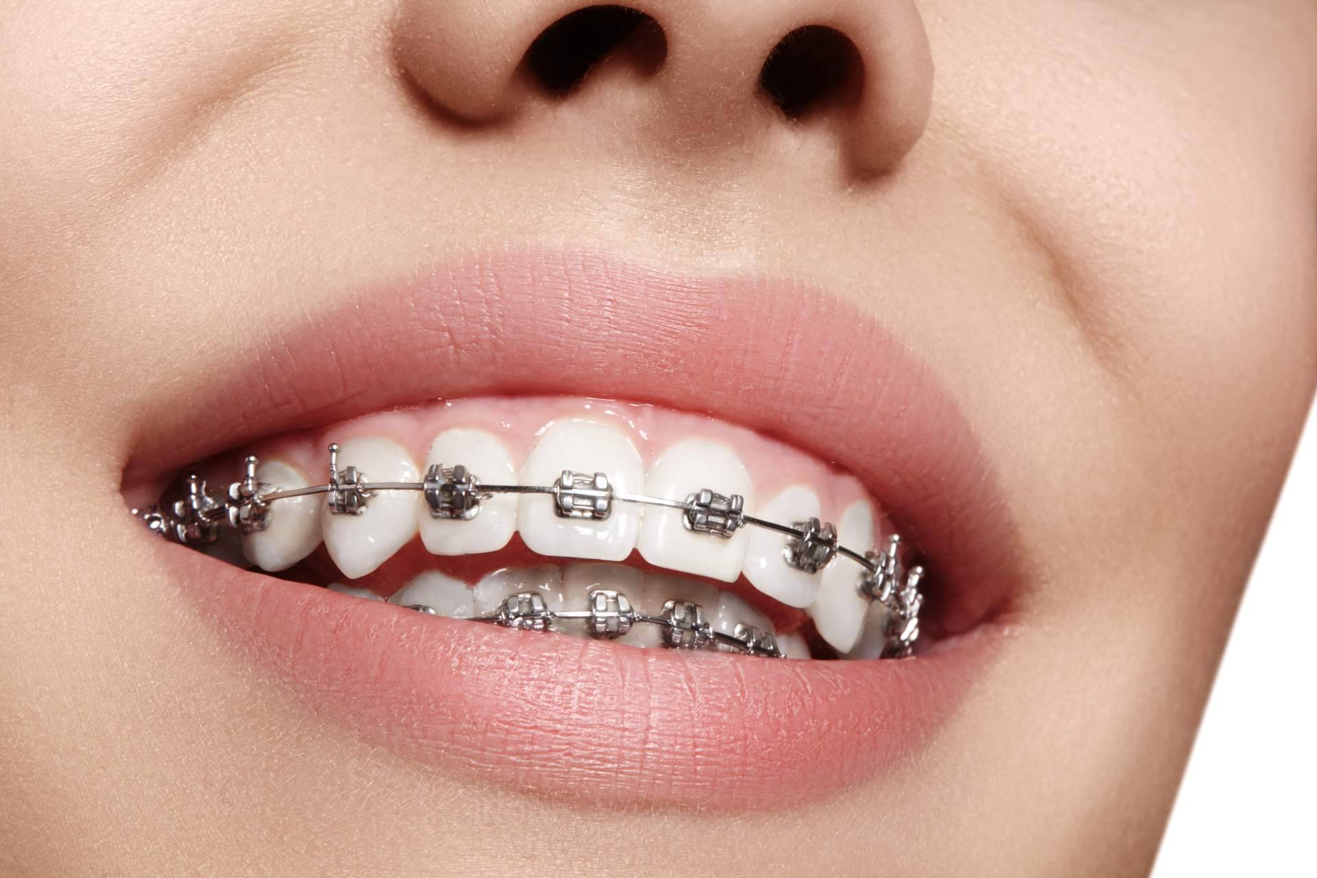 Clínica Sonrisas ofrece servicios de ortodoncia Insignia en Badajoz