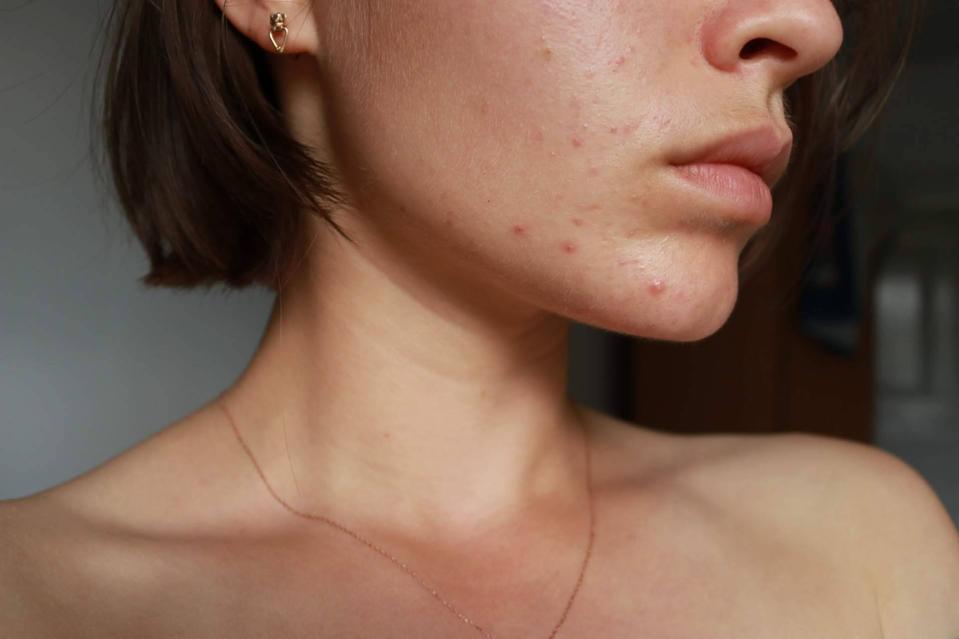 Combatir el acné con la Clínica Tarrazo