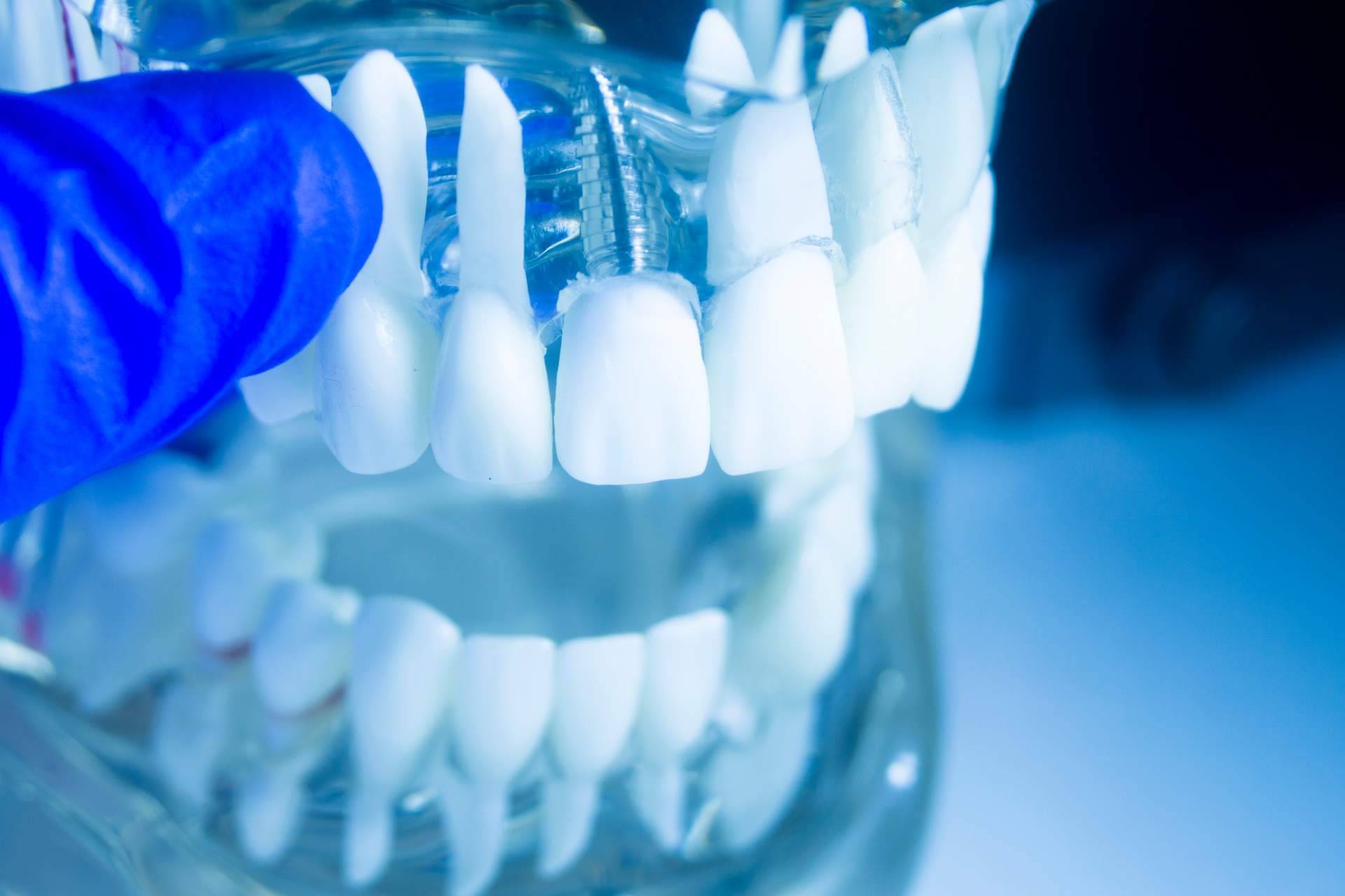 Los dientes fijos en un día son una realidad tras el trabajo de la Clínica dental especializada Artydents en Madrid