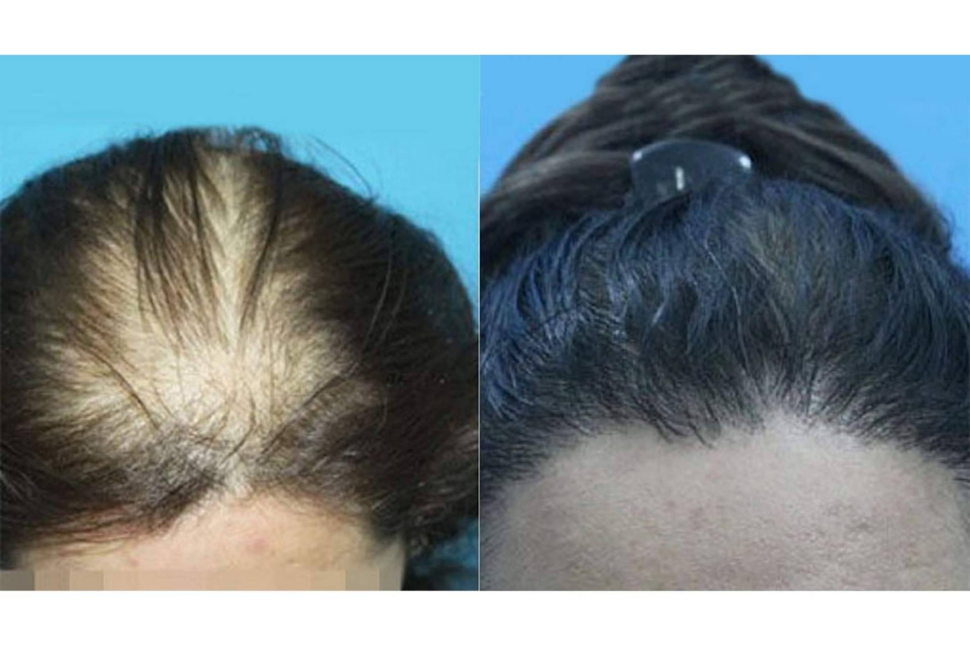 Trasplante capilar para mujeres que sufren alopecia femenina, por Innovación Capilar