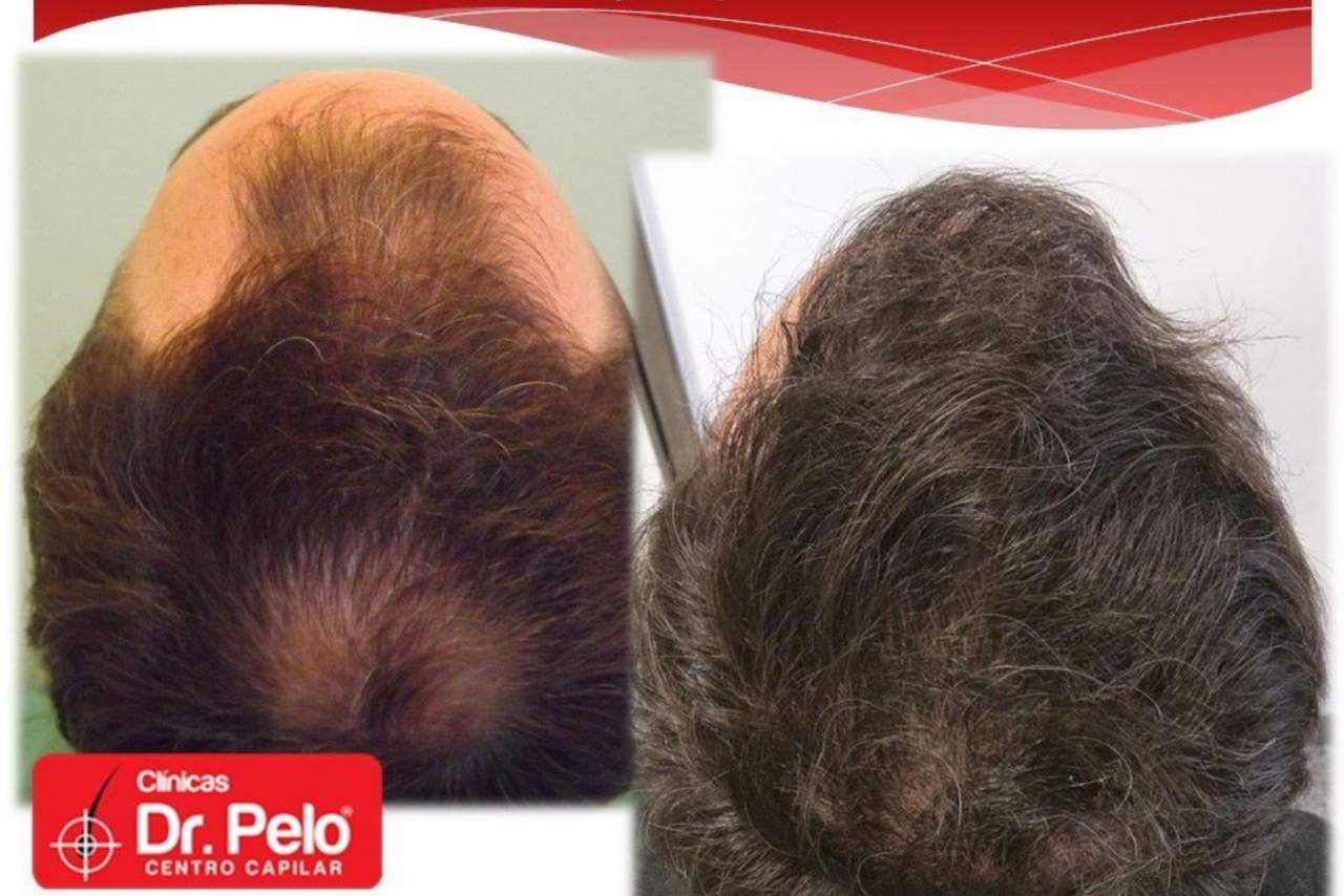 Dr. Pelo: ¿Es el trasplante capilar la nueva tendencia de la medicina estética?