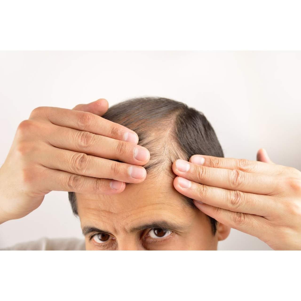 Dr. Carlos Zito: Prevenir la caída del cabello en Barcelona