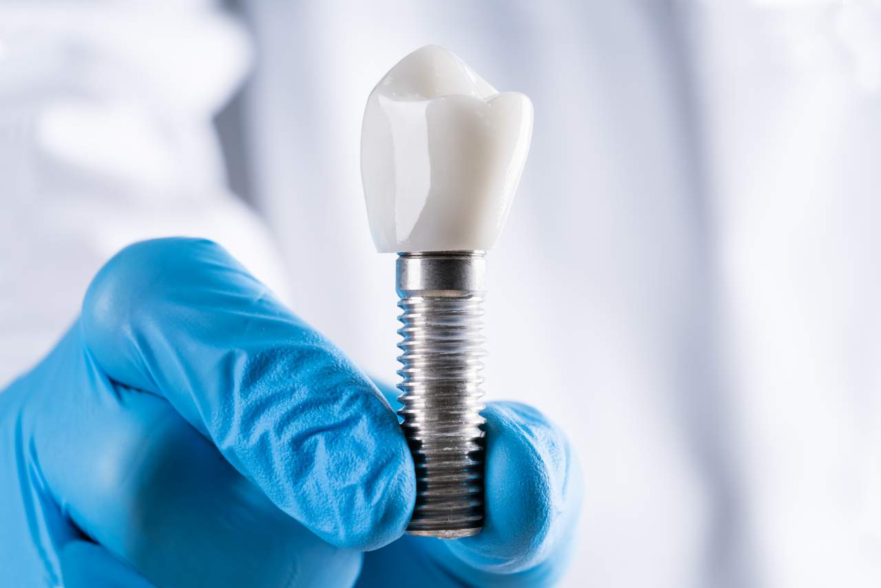 Los dentistas de la Clínica Helident Sevilla recomiendan el uso de la mejor calidad en implantes