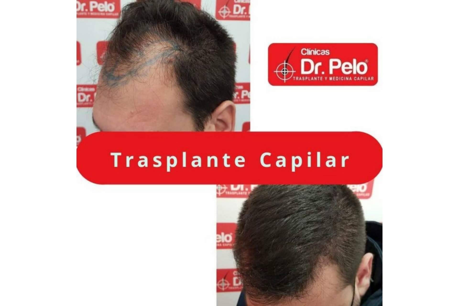 El injerto capilar en Sevilla gana popularidad gracias a las Clínicas Dr. Pelo