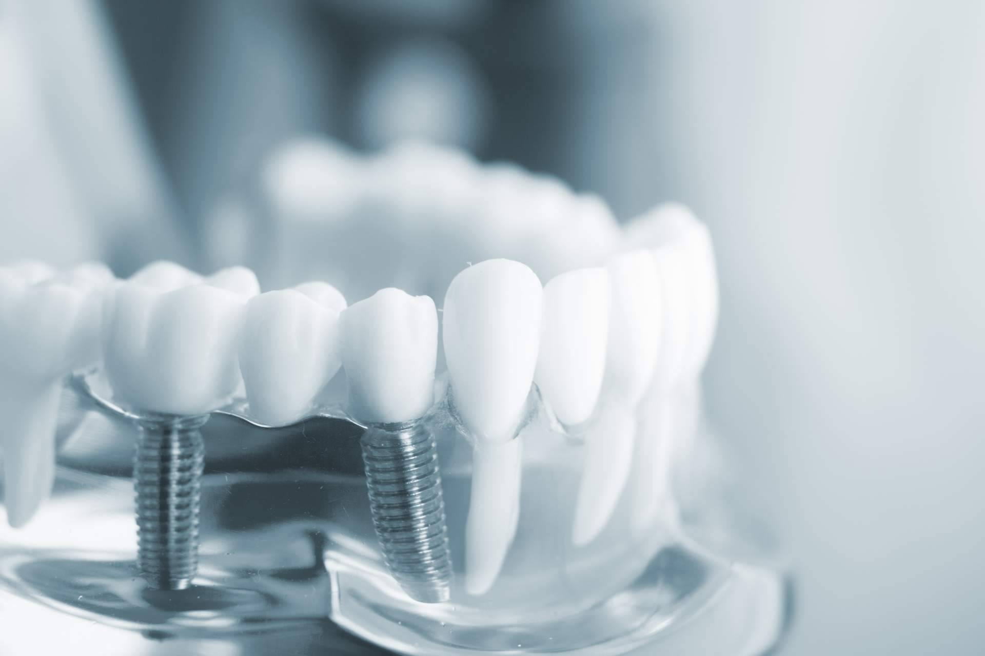 Dientes fijos en un solo día gracias a los implantes dentales de titanio V de la Clínica Artydents en Madrid