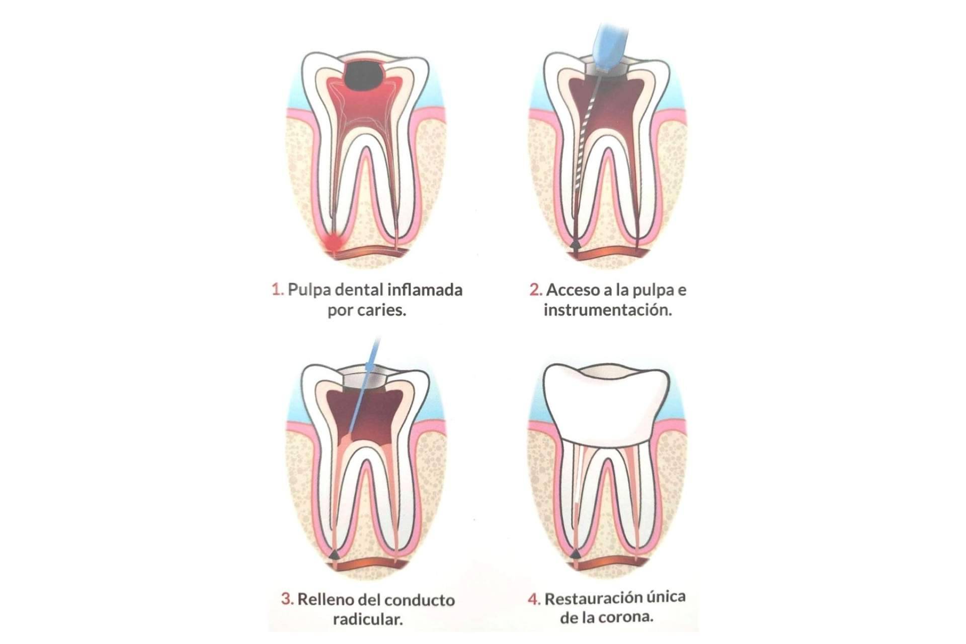 El procedimiento de endodoncia que realiza Implant Clinics