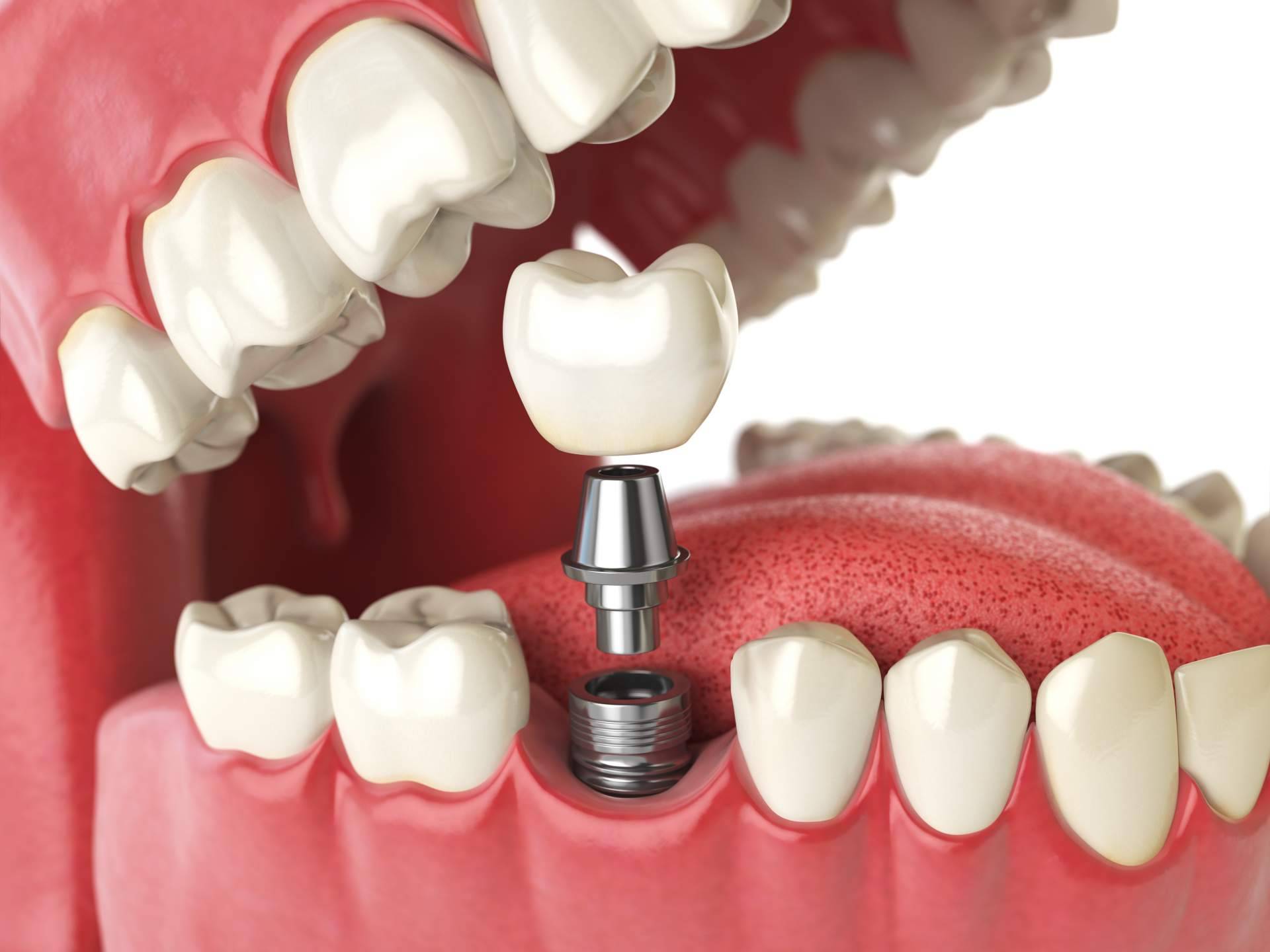 Implante dental de titanio en la Clínica de Odontología Artydents de Madrid por solo 199€