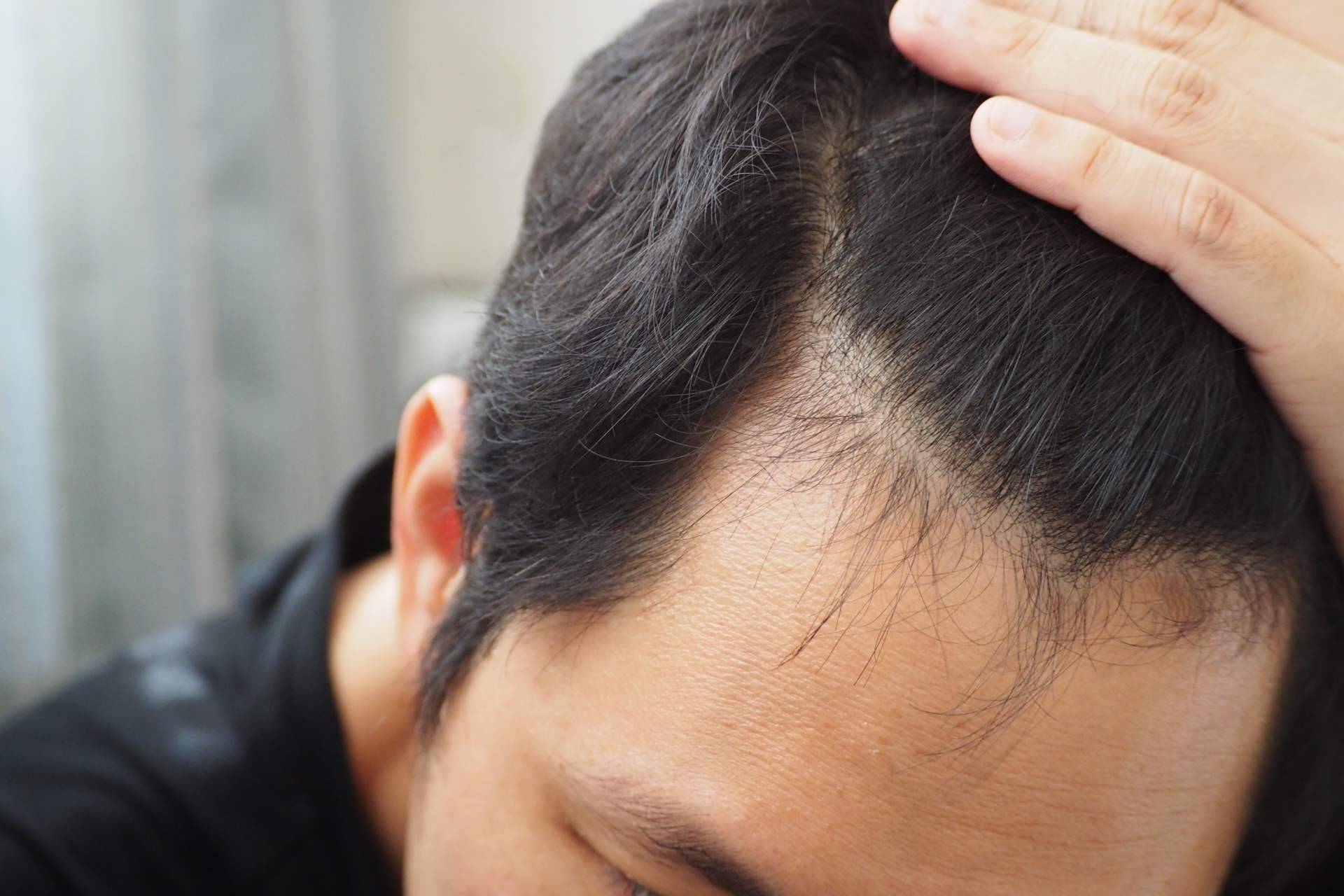 ¿En qué consiste la micropigmentación capilar?, por Élite Capilar
