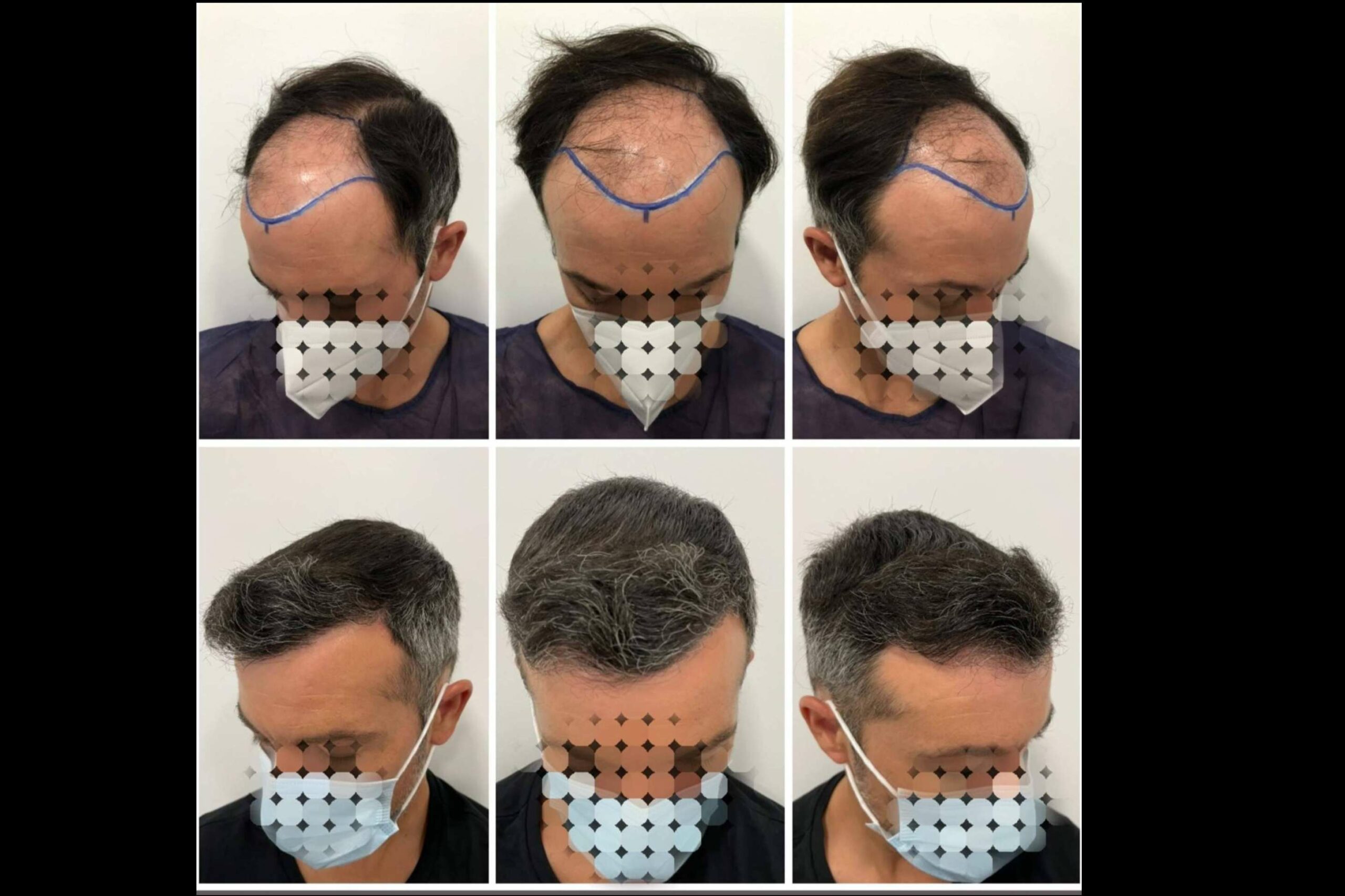 Injerto o trasplante capilar: ¿Cuáles son las técnicas más recomendadas por el especializado Dr Bruno Jacobovski?
