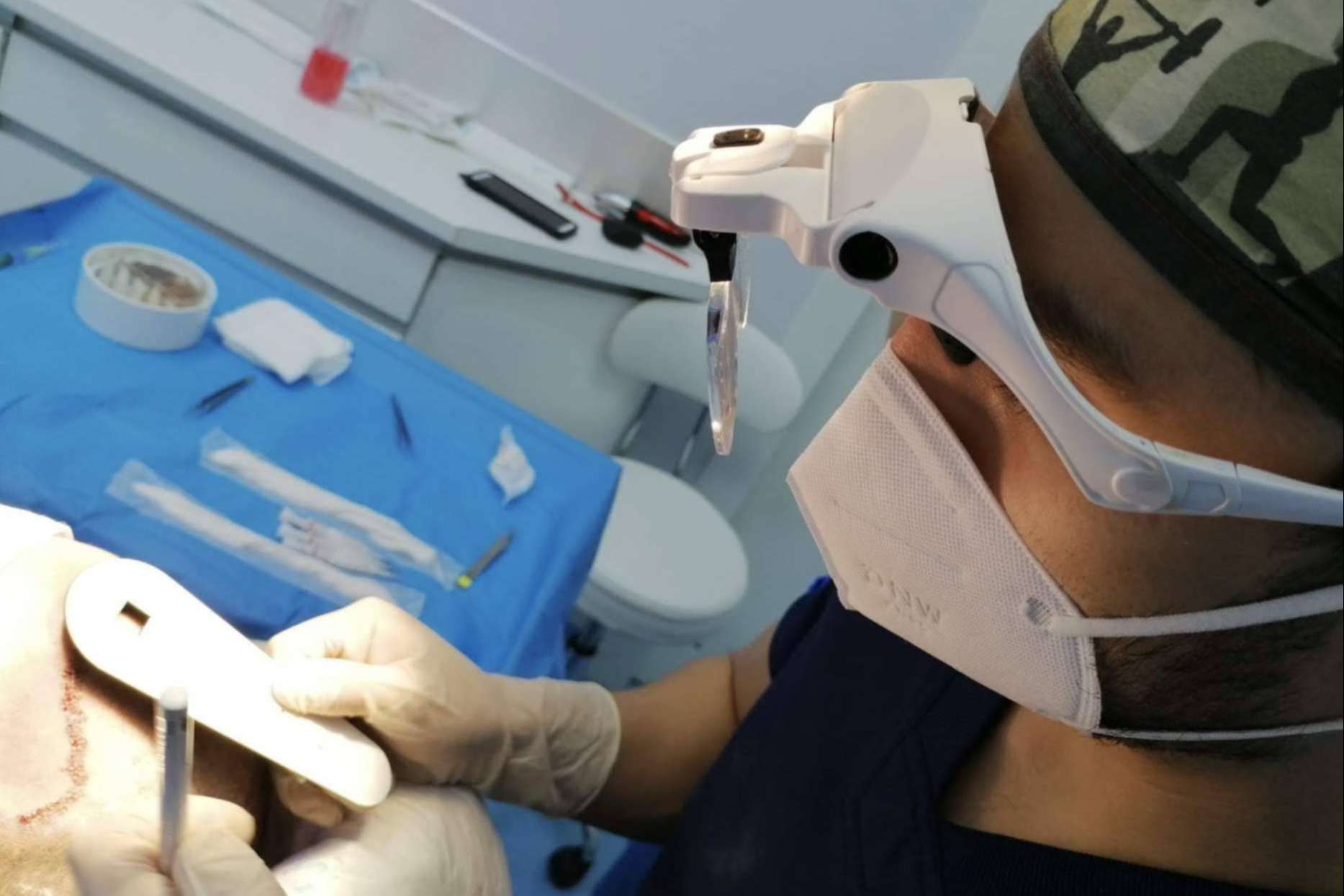 La fase del desierto capilar: ¿Cuándo se cae el pelo implantado?, según Doctor Bern