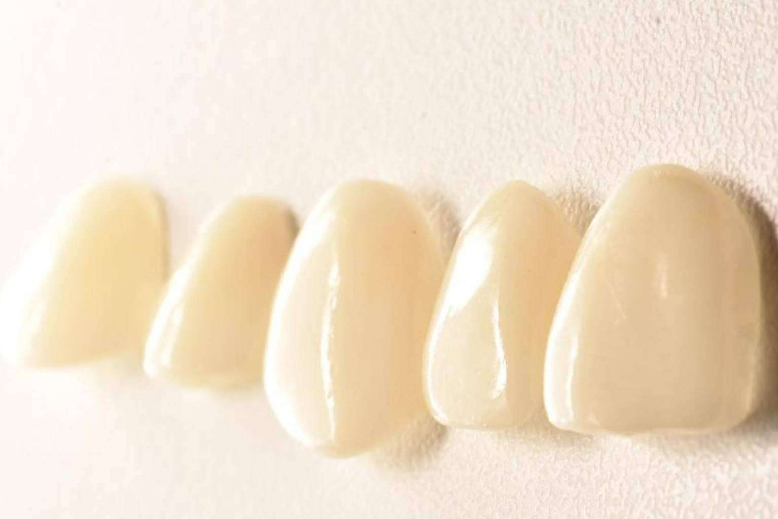 Sonrisa perfecta con tratamientos 0 invasivos: las carillas Emax y las inyectadas de composite de Implant Clinics