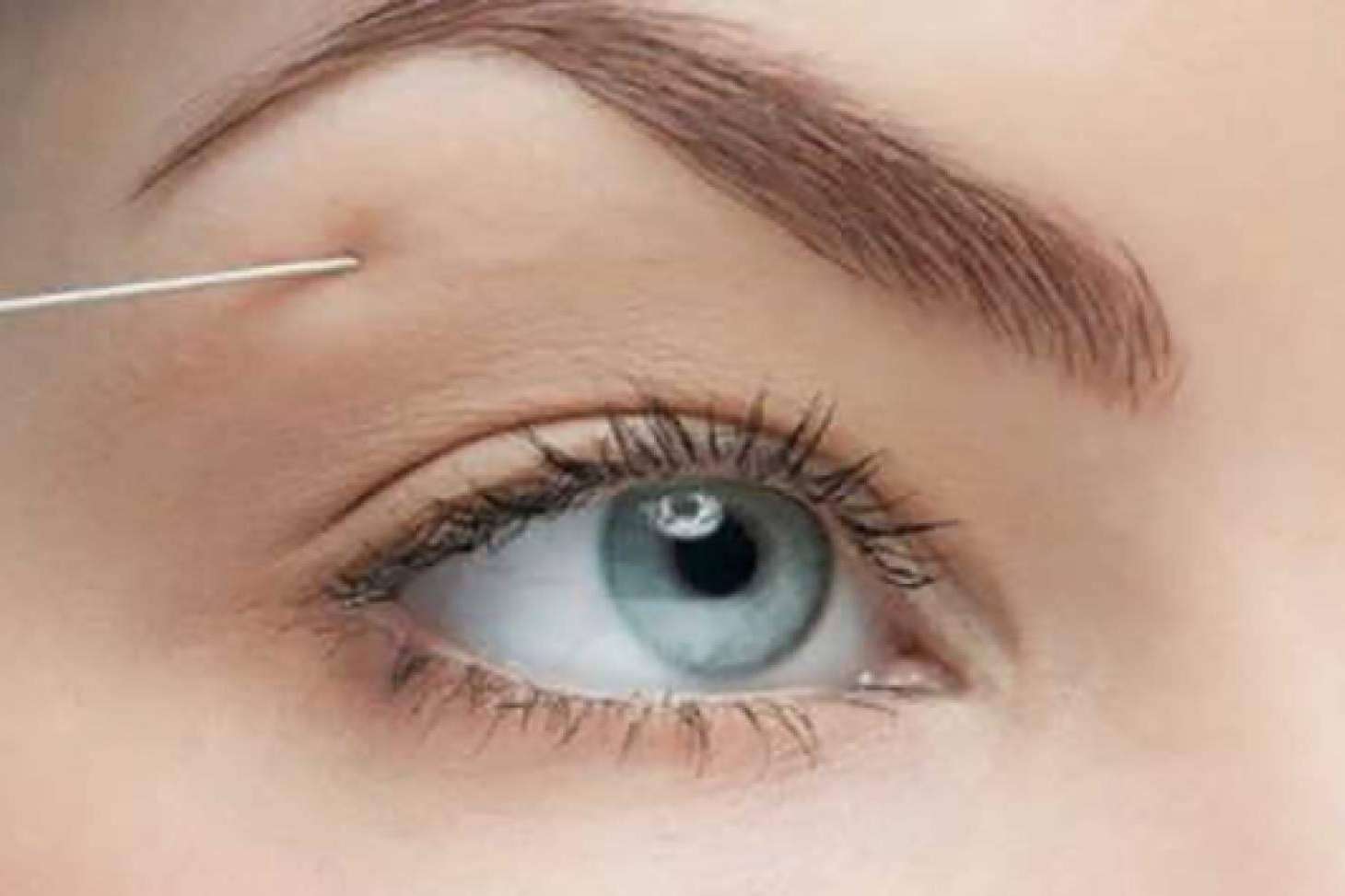 Diseño de cejas con bótox en la Clínica de Medicina Estética Sánchez Peral en Castellón