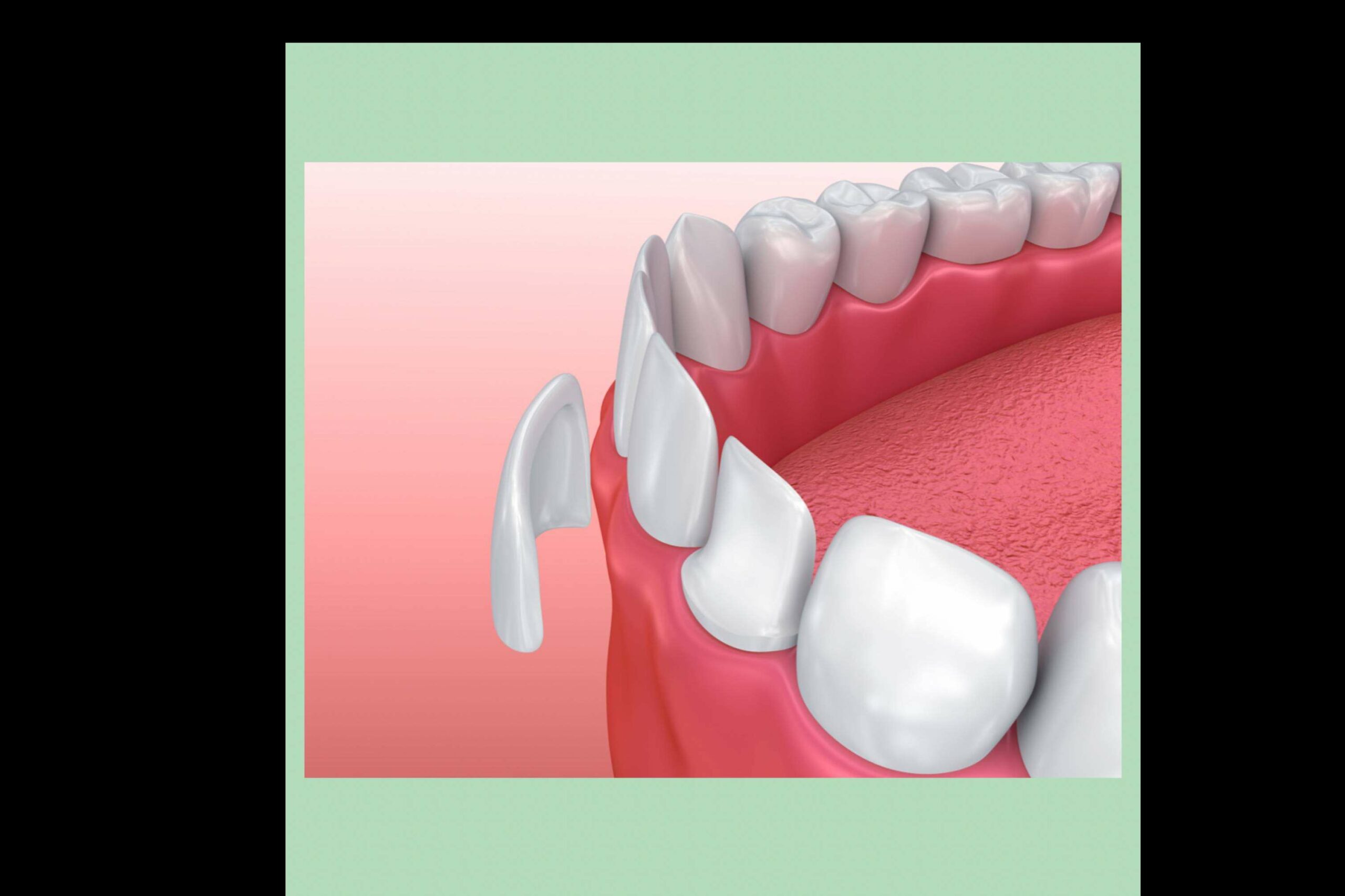 El servicio de carillas dentales en la Clínica Paula Vidal