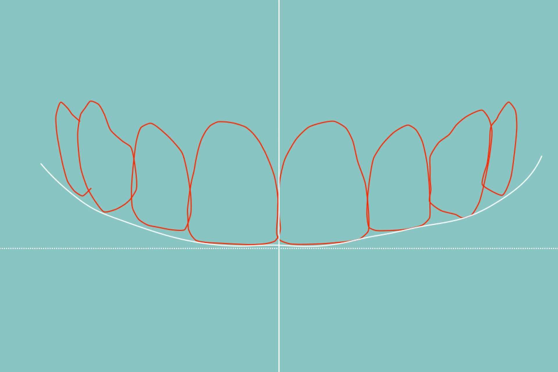 Tecnología de vanguardia para el diseño de sonrisa en Clínica Dental Blay + Monzó