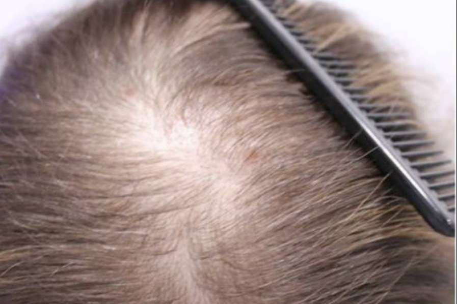 Tipos de alopecia femenina y métodos para combatirla según Injermur