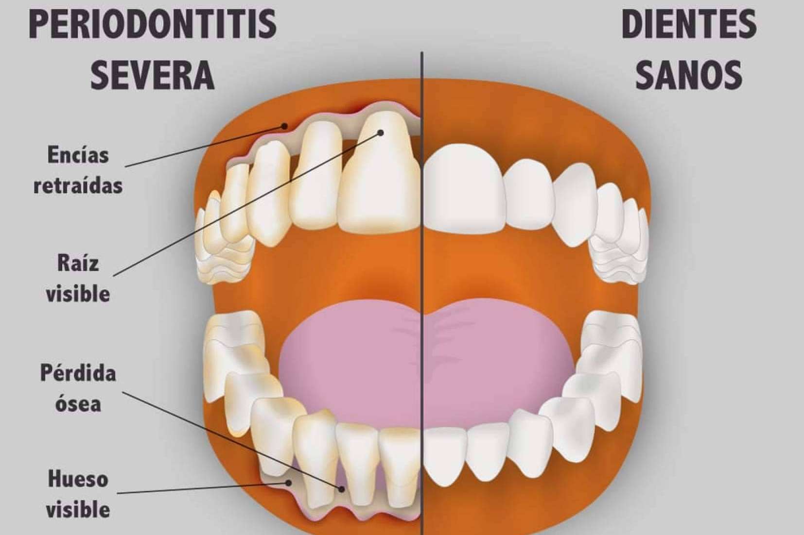 opción eficientemente Tender Qué es y cómo tratar una enfermedad periodontal?, por Implant Clinics