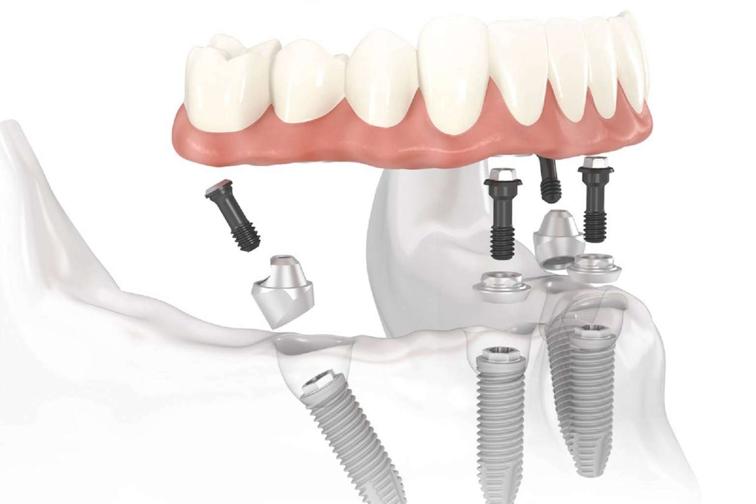 Realizar implantes dentales en un día es posible con la tecnología digital de Dentinova
