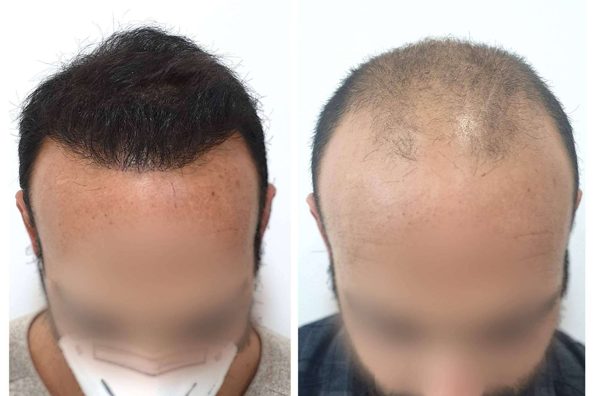 ¿Cómo se puede combatir la alopecia androgénica?