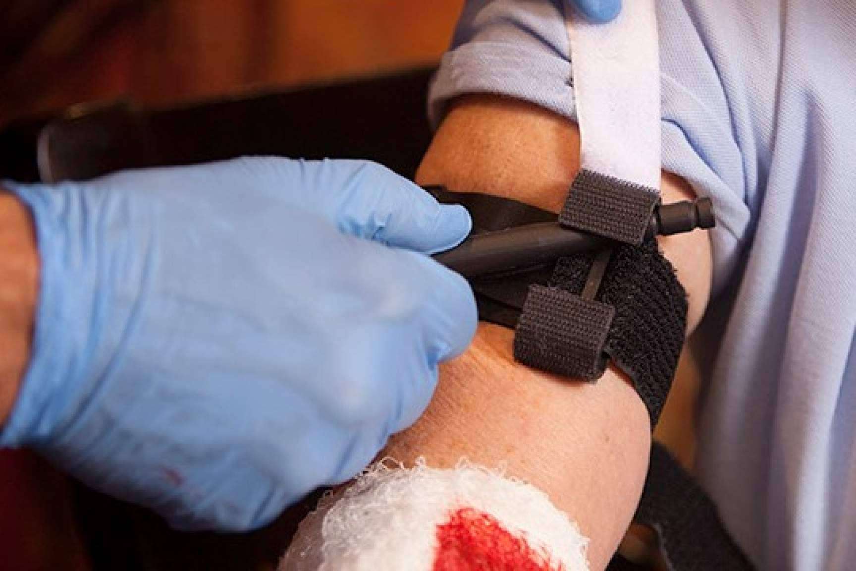 ¿Cuándo y cómo se debe colocar un torniquete?
