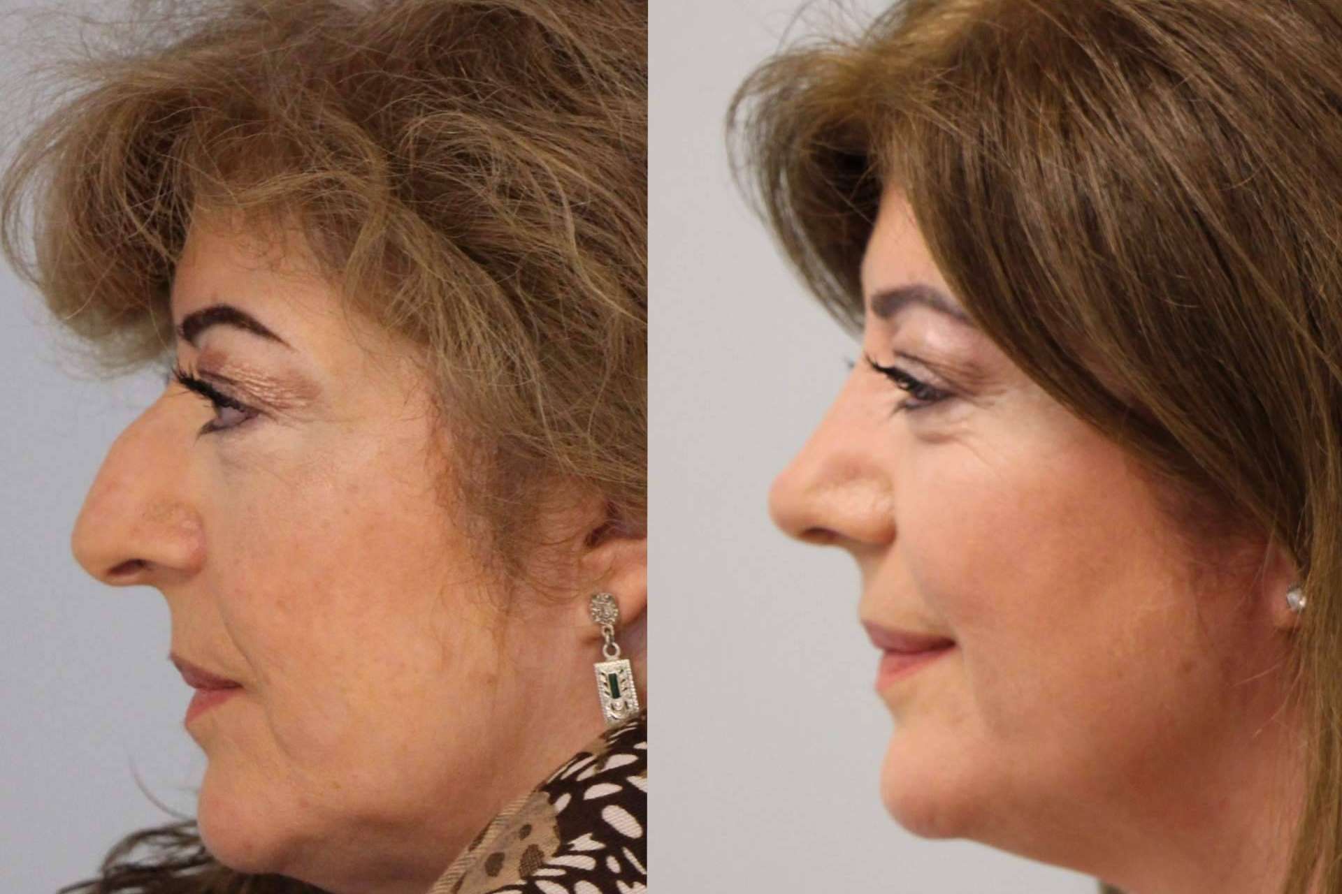 Qué hacer antes de pasar por una rinoplastia ultrasónica, por el Dr. Pérez Villar