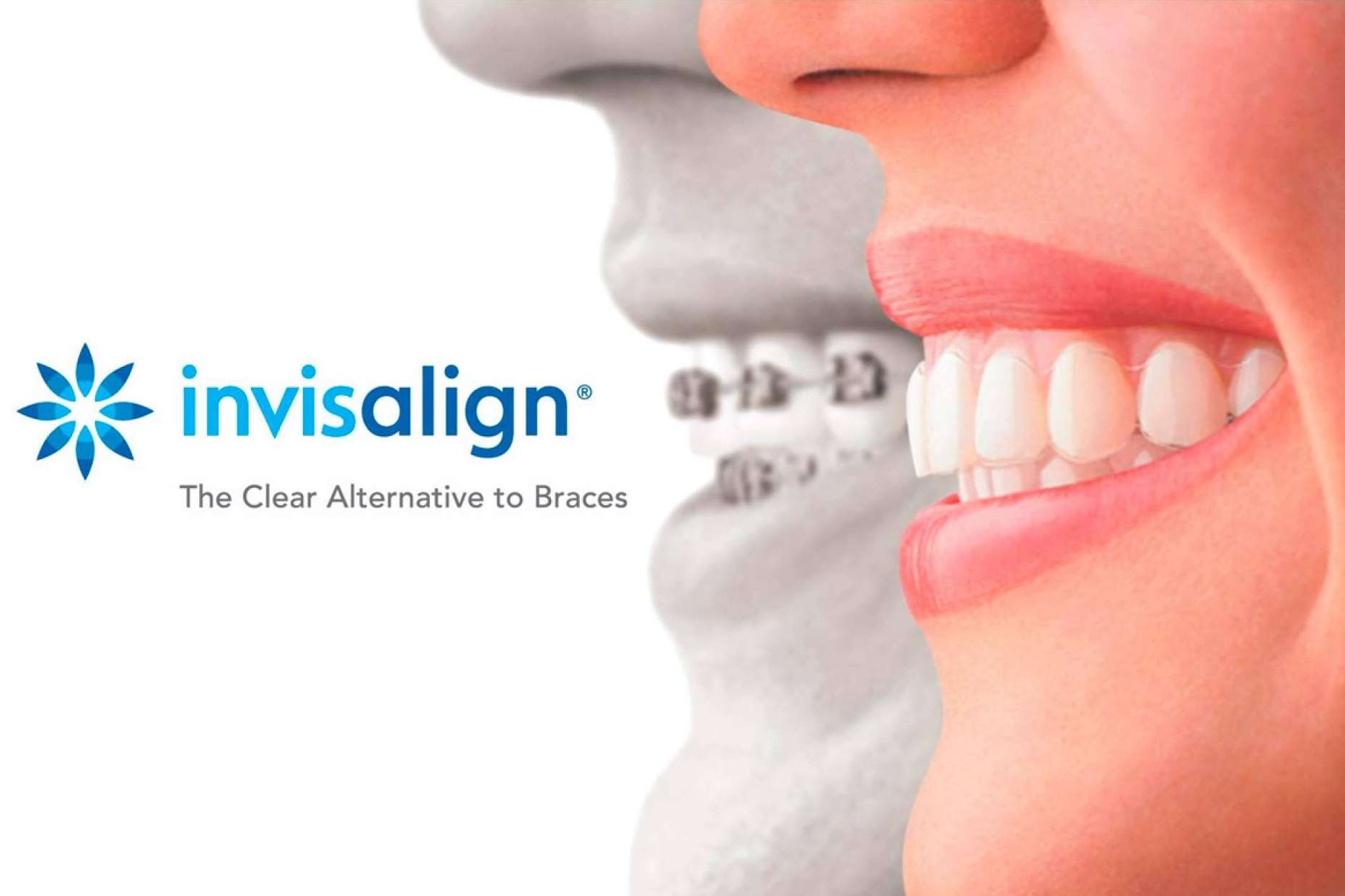 Ortodoncia invisible Invisalign, la tecnología que garantiza estética y comodidad