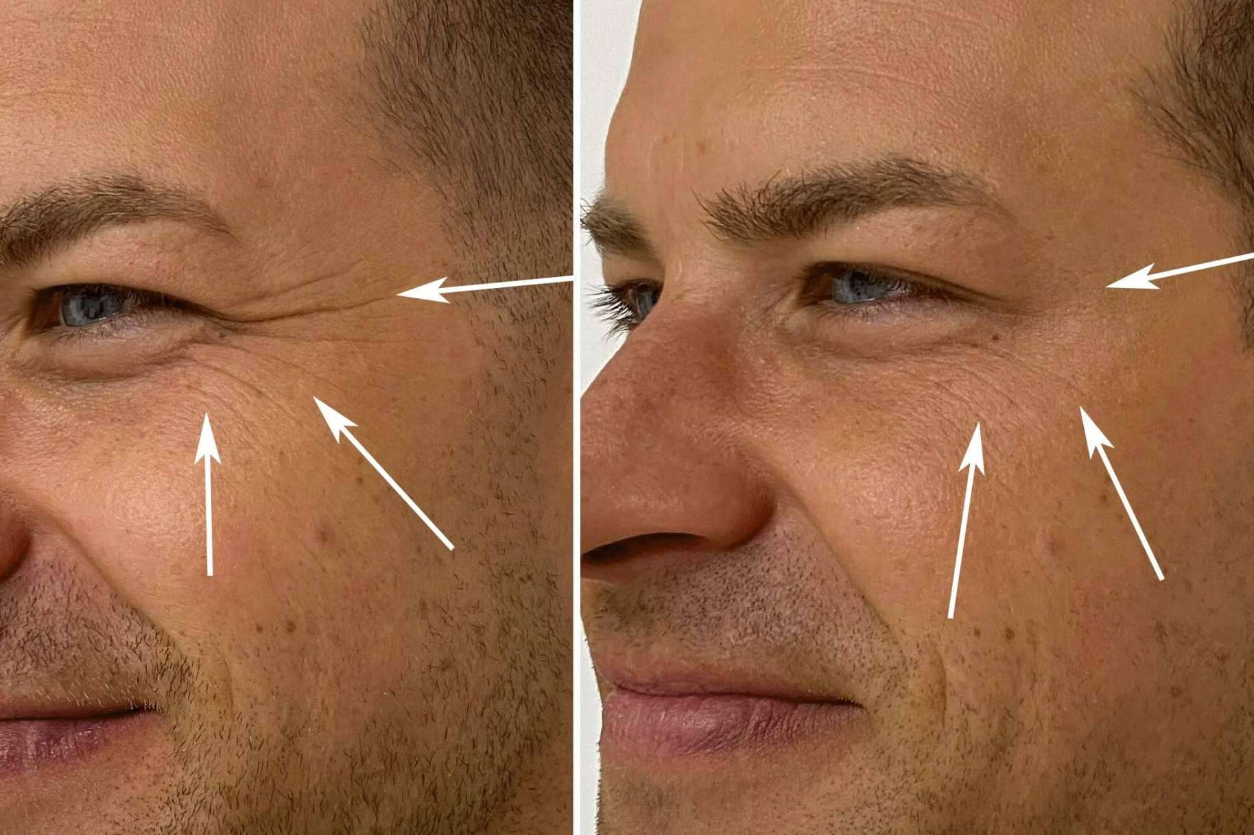 El bótox es el tratamiento ideal para reducir las arrugas de la frente, entrecejo y patas de gallo