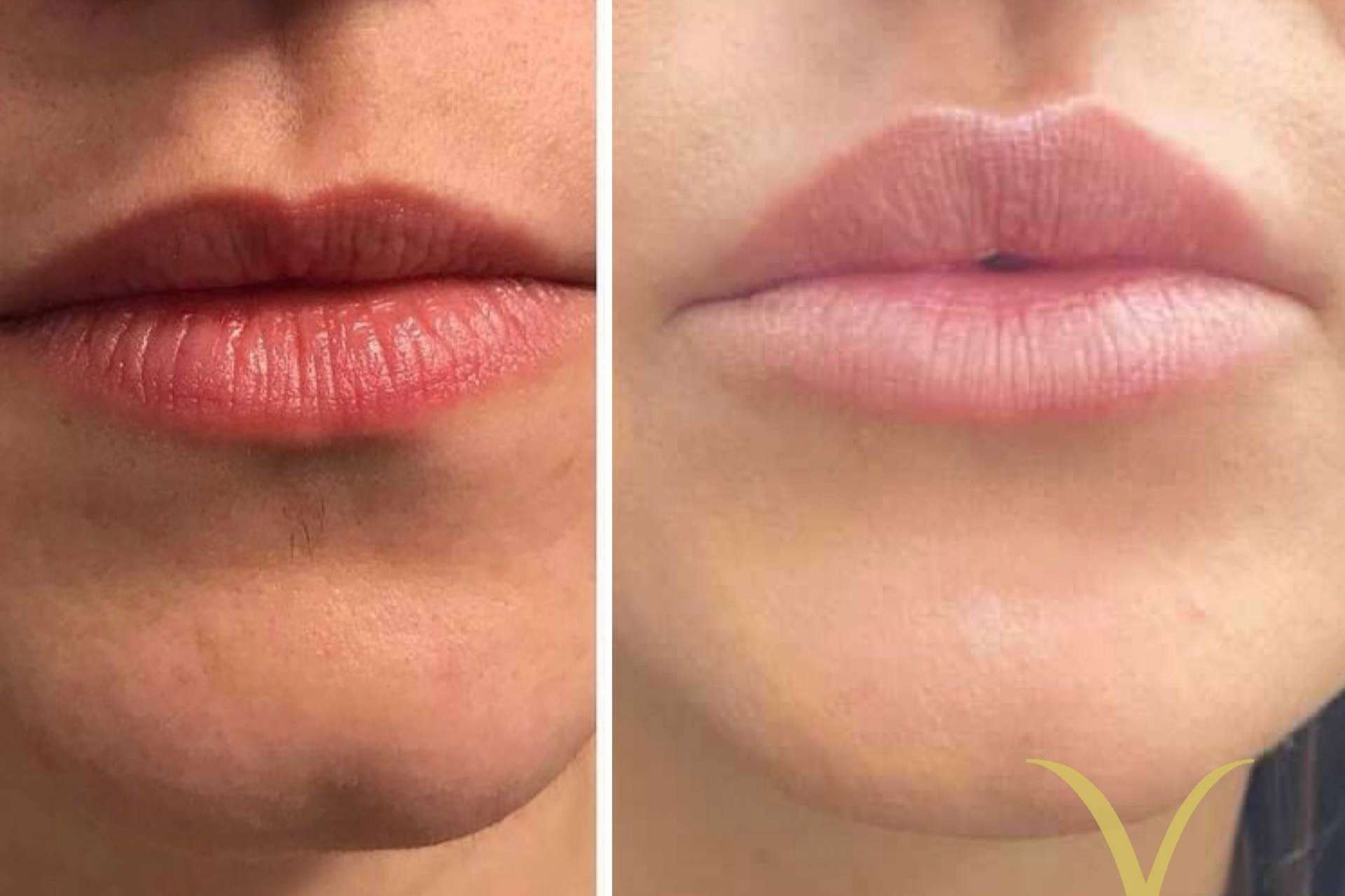 El tratamiento de aumento de labios que realiza la Clínica Yasmin
