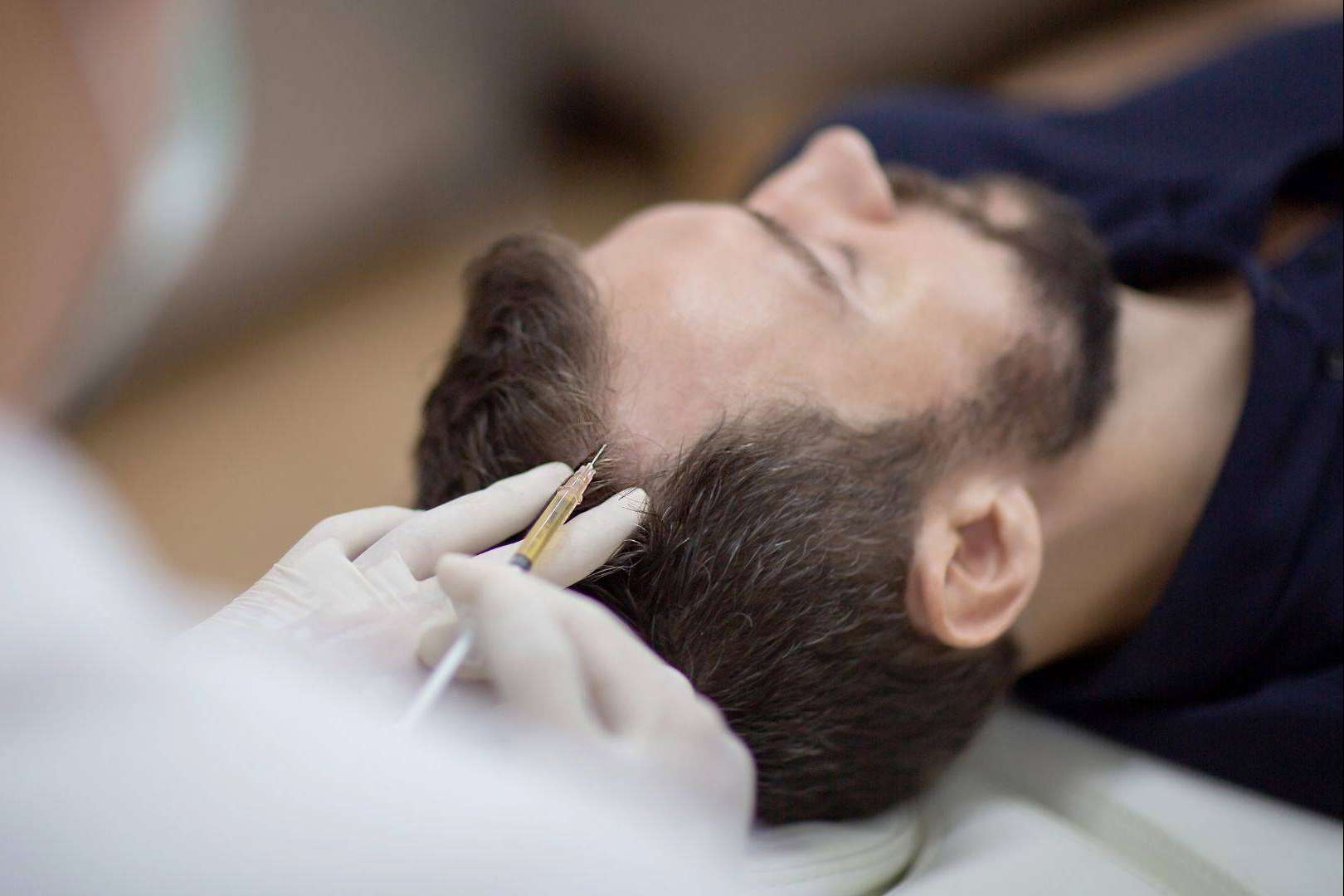 Plasma rico en plaquetas y dutasterida, la potente terapia regenerativa de doble efecto contra la caída del cabello