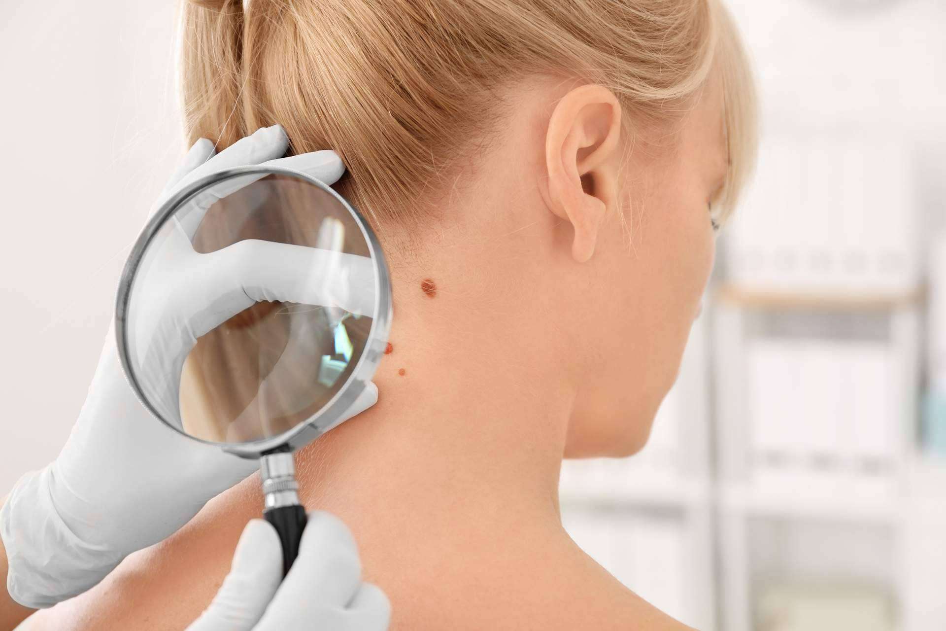 Eliminación de verrugas y lunares con tecnología de vanguardia en el Centro Médico El Pilar
