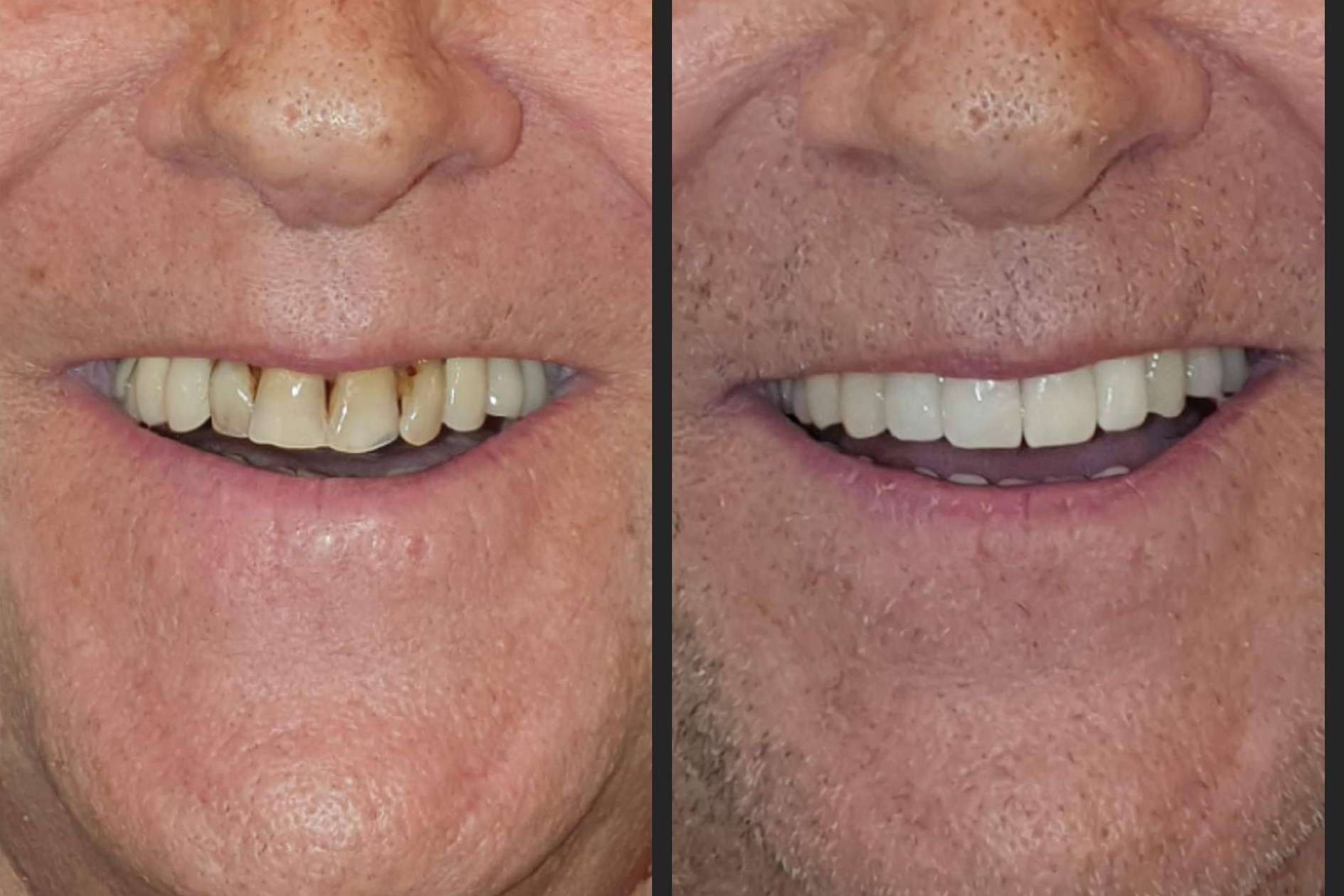 Alineación dentaria sin ortodoncia, por Dentinova